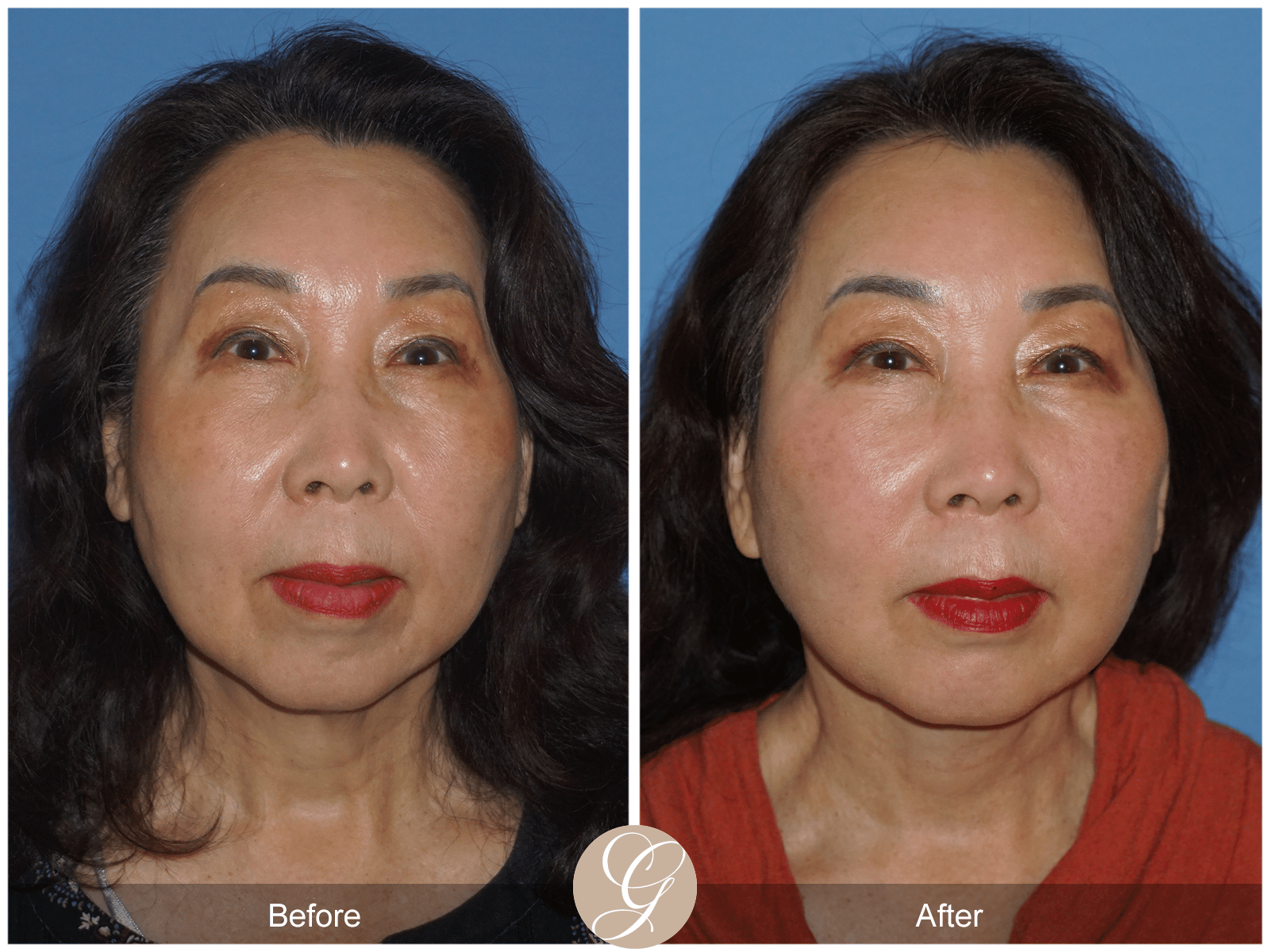 Facelift Case 9 Image