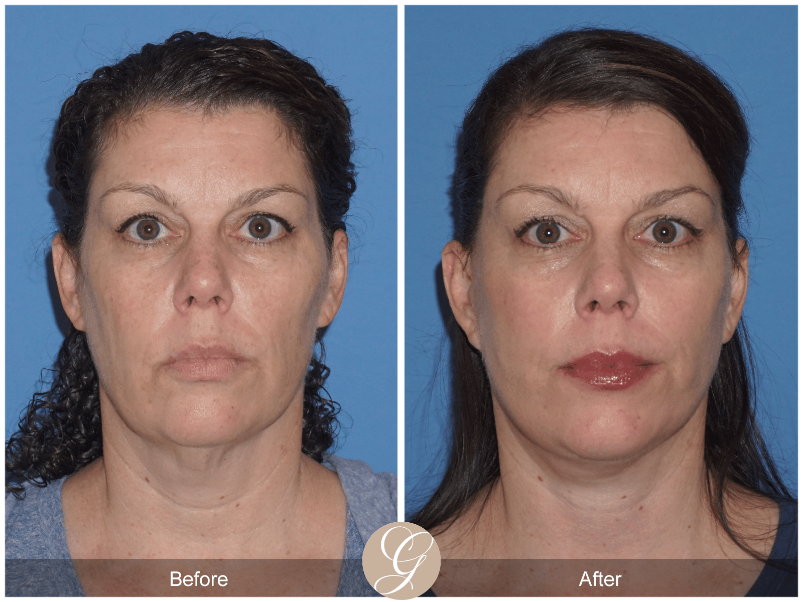 Facelift Case 10 Image