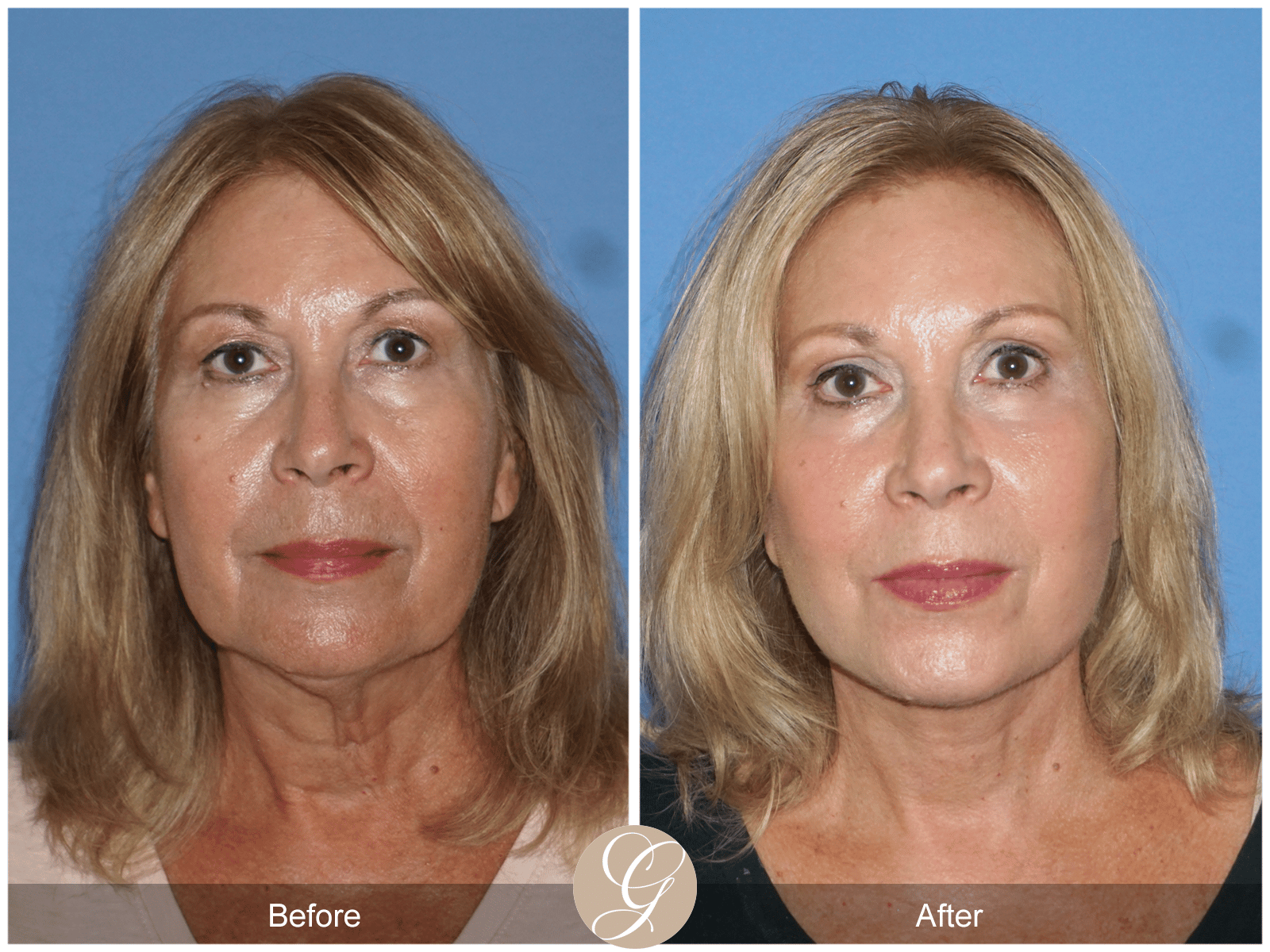 Facelift Case 12 Image