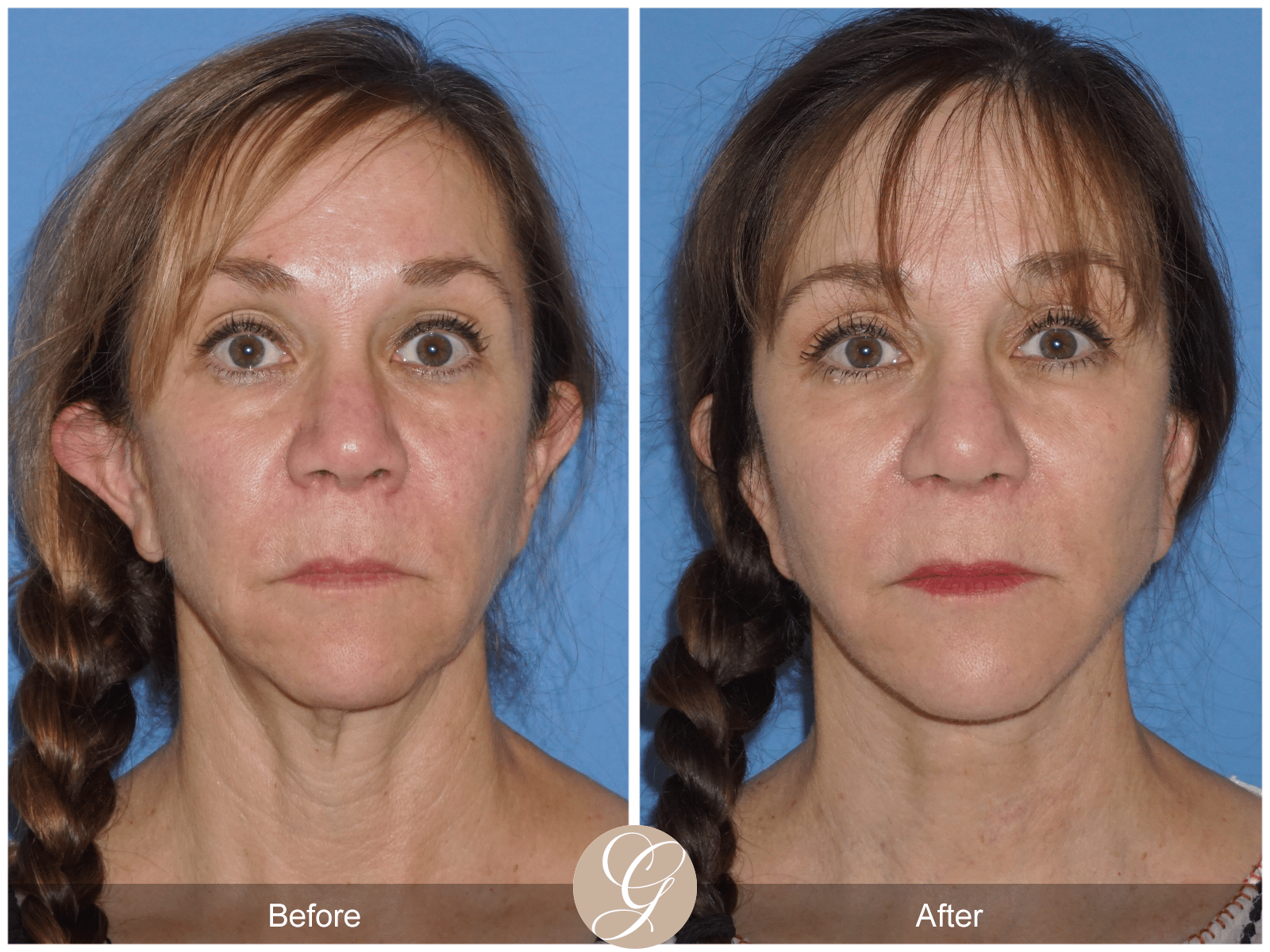 Facelift Case 14 Image