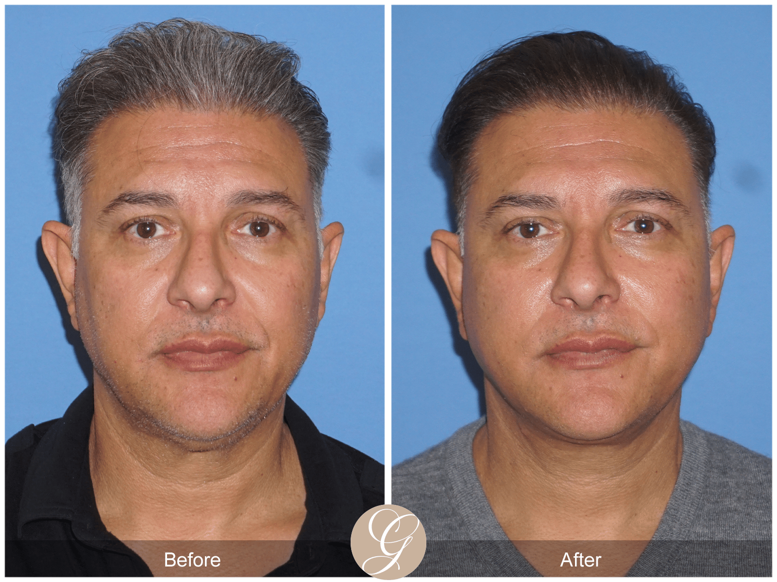 Facelift Case 16 Image