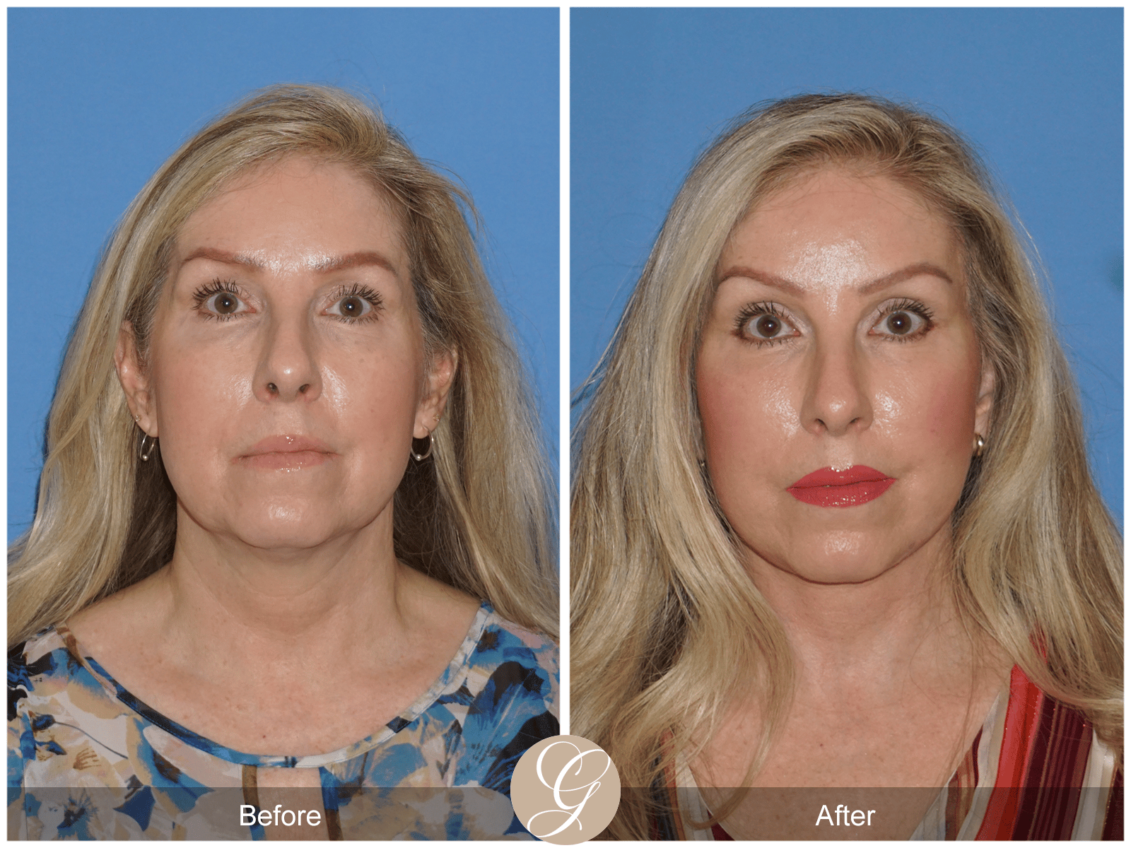 Lower Face and Neck Lift Case 4 Image