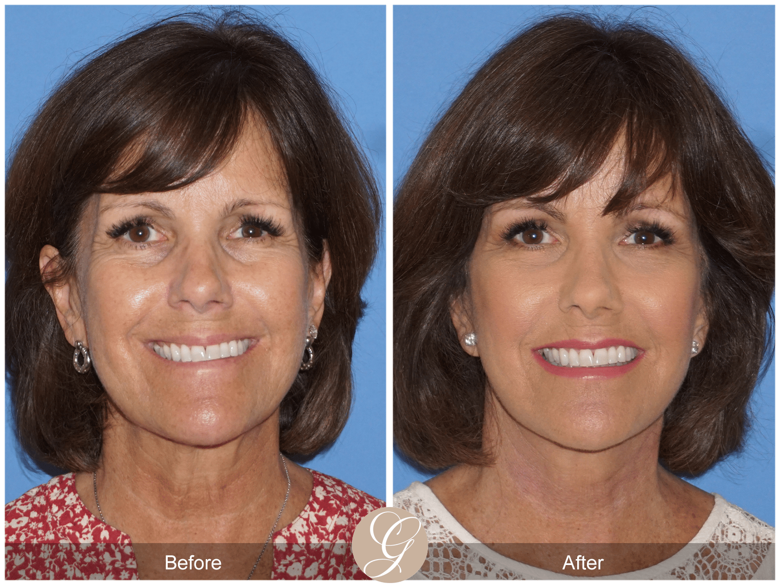 Facelift Case 17 Image