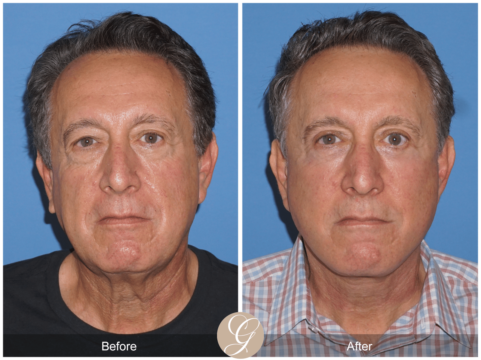 Lower Face and Neck Lift Case 7 Image