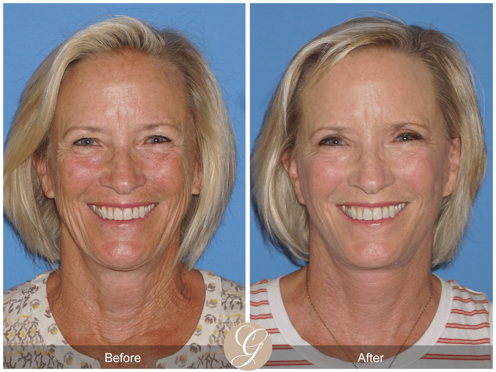 Lower Face and Neck Lift Case 6 Image