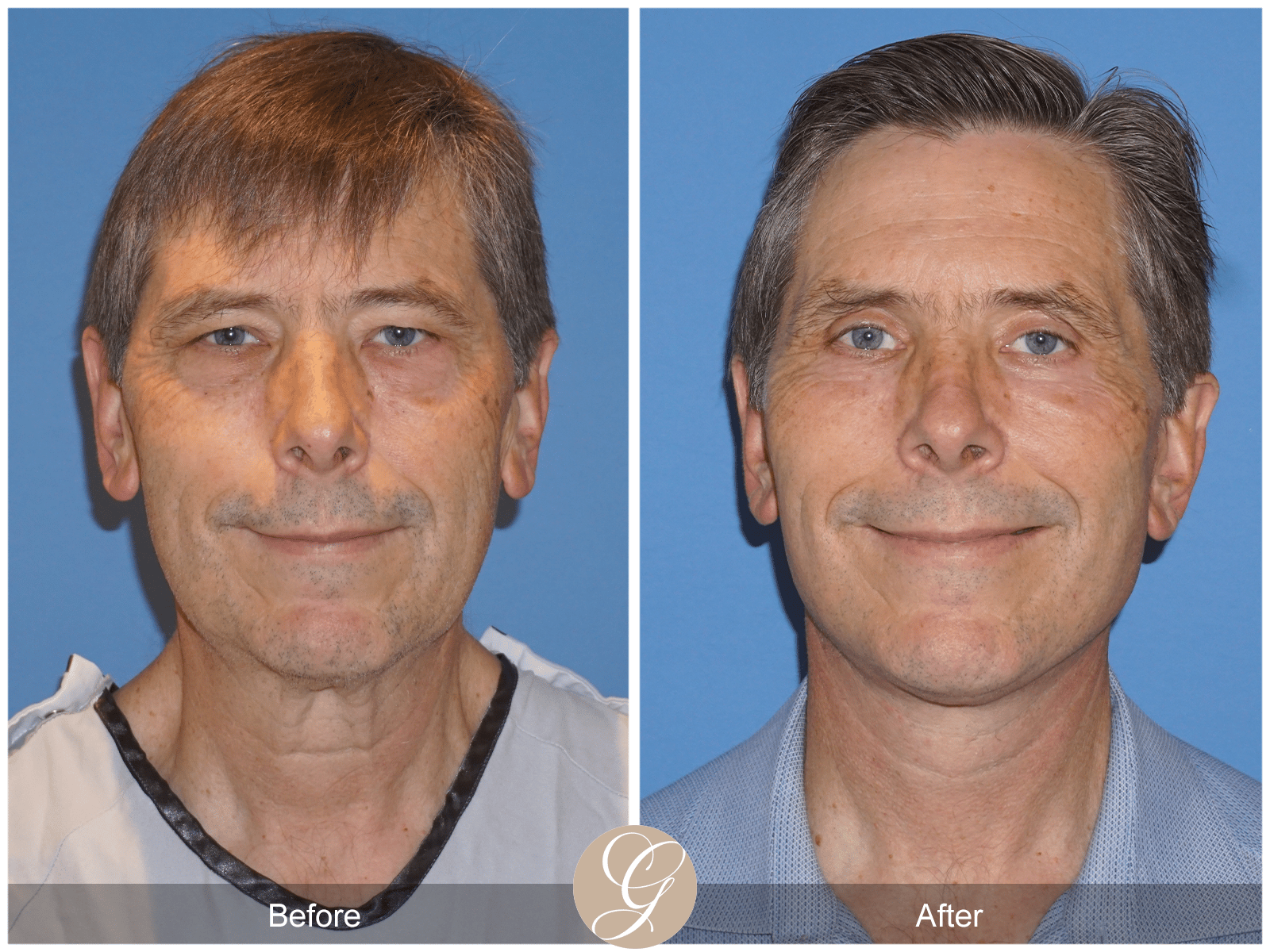 Lower Face and Neck Lift Case 5 Image