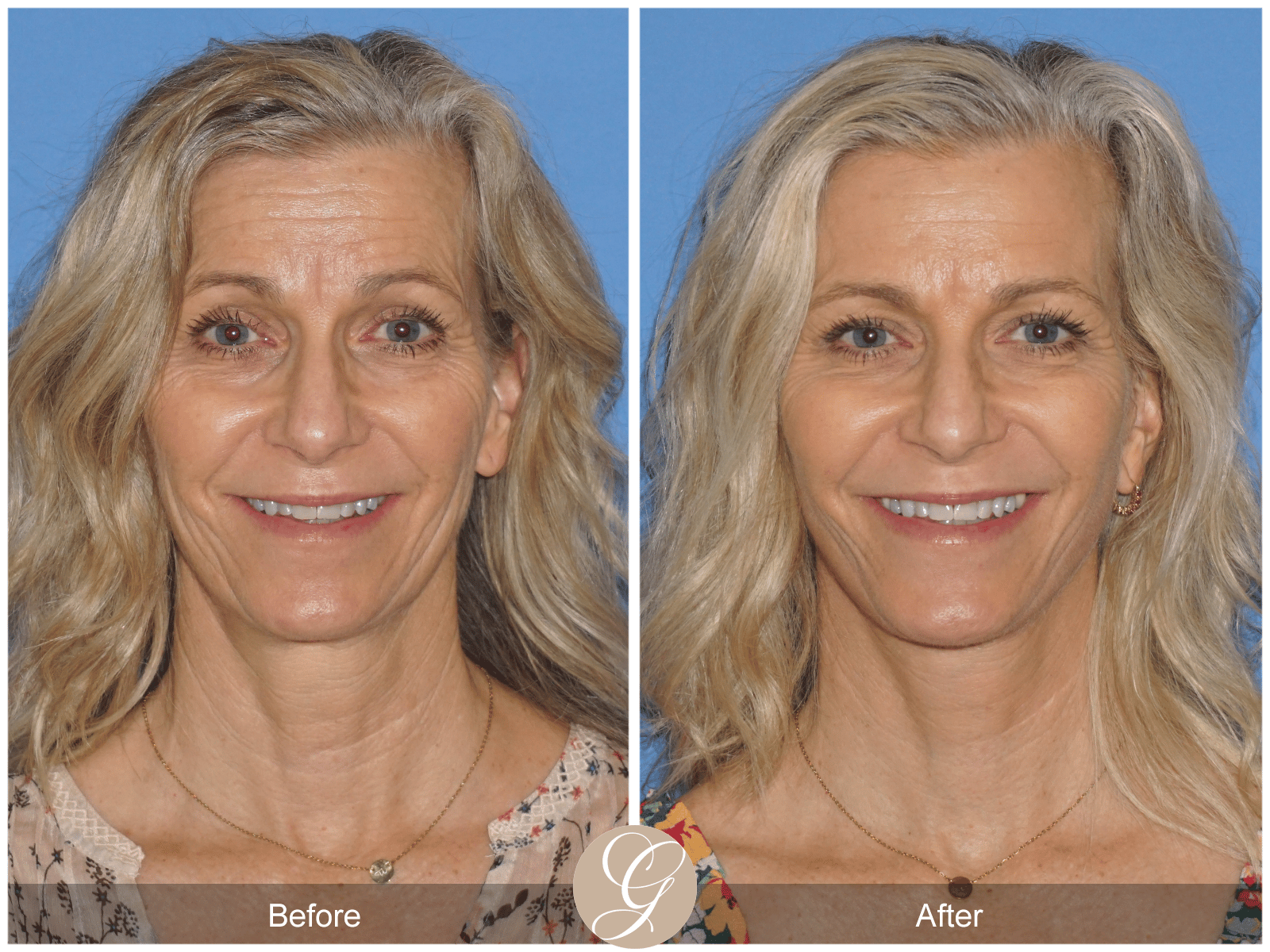 Lower Face and Neck Lift Case 1 Image