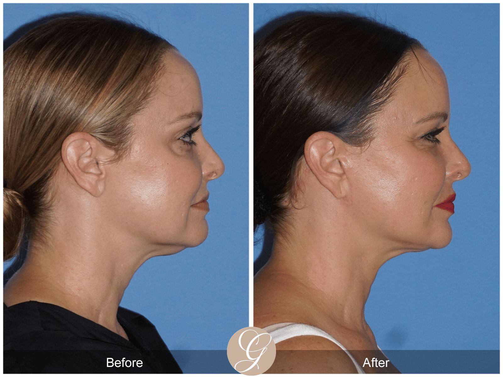 Lower Face and Neck Lift Case 2 Image
