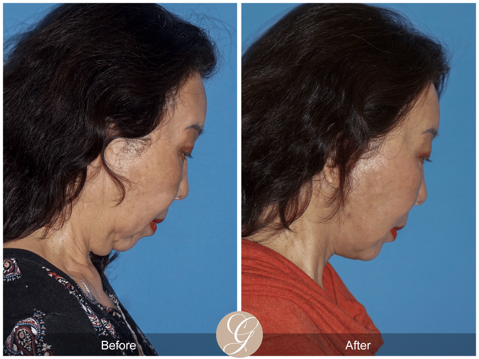 Facelift Case 9 Image