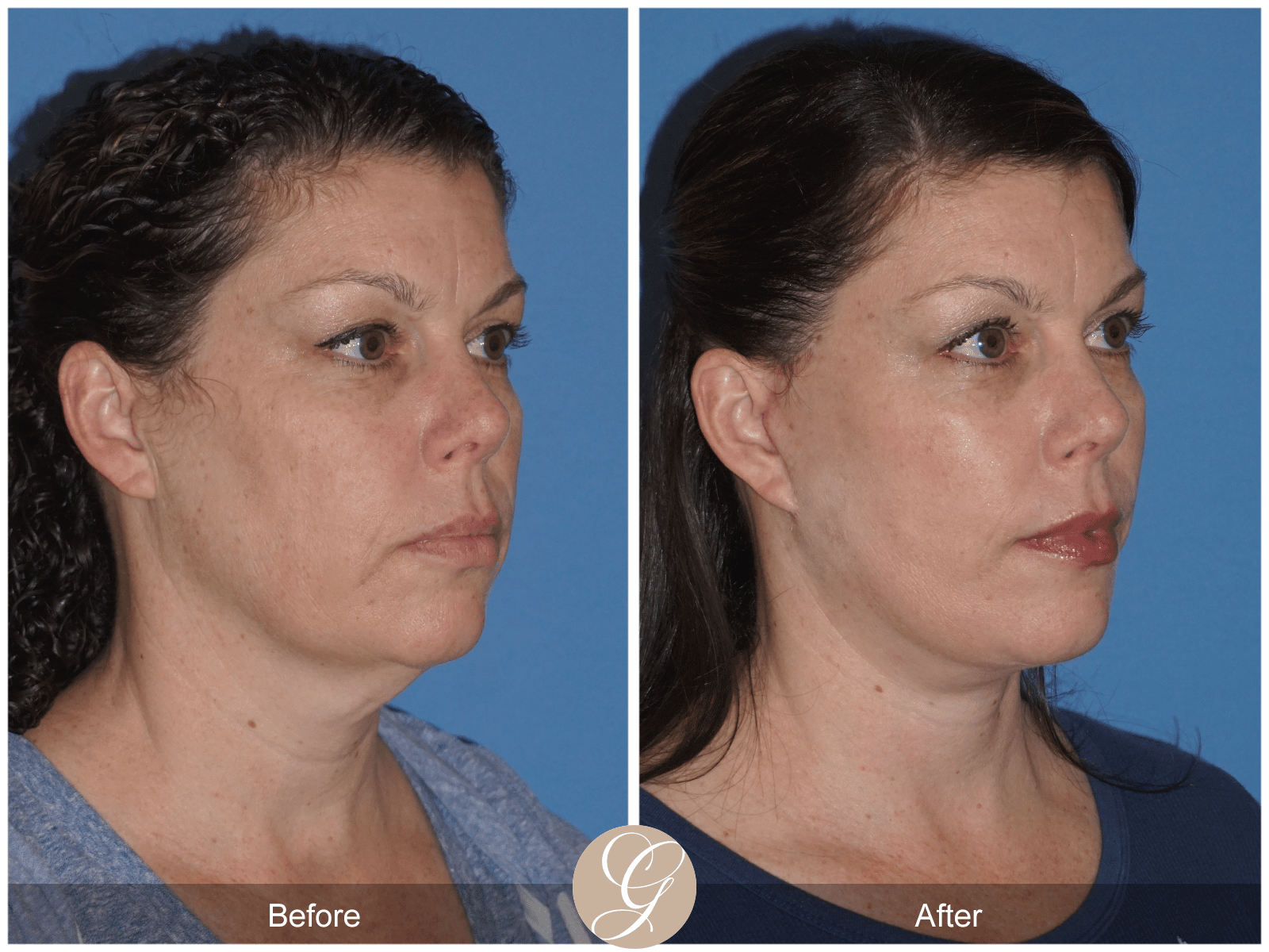 Facelift Case 10 Image