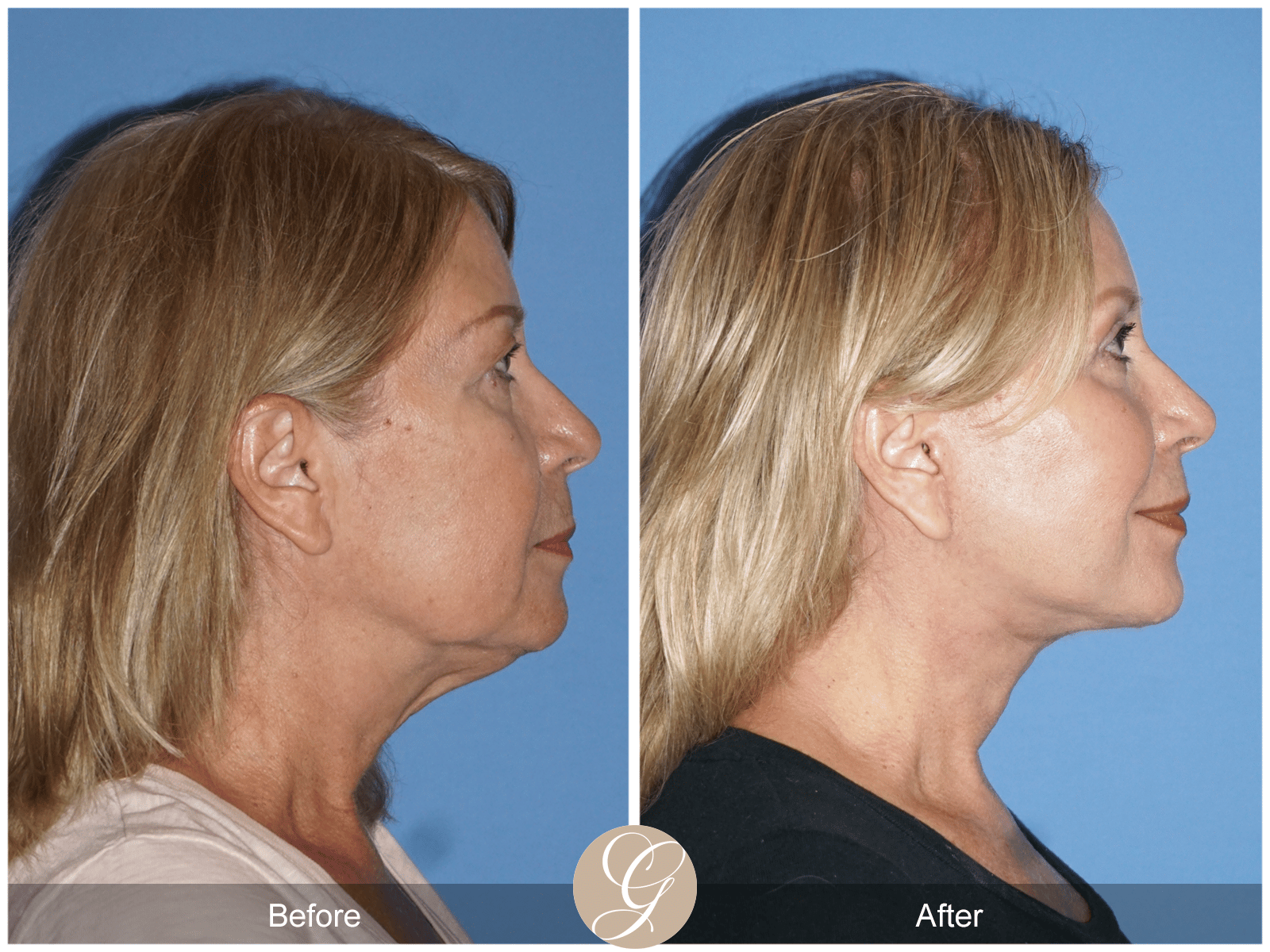 Facelift Case 12 Image