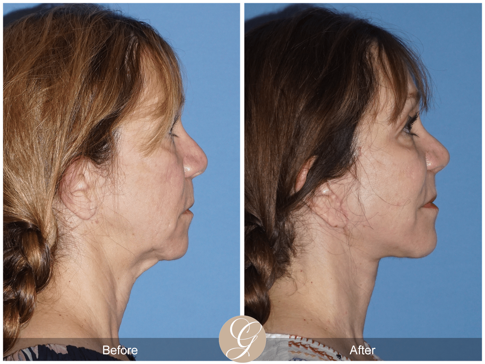 Facelift Case 14 Image