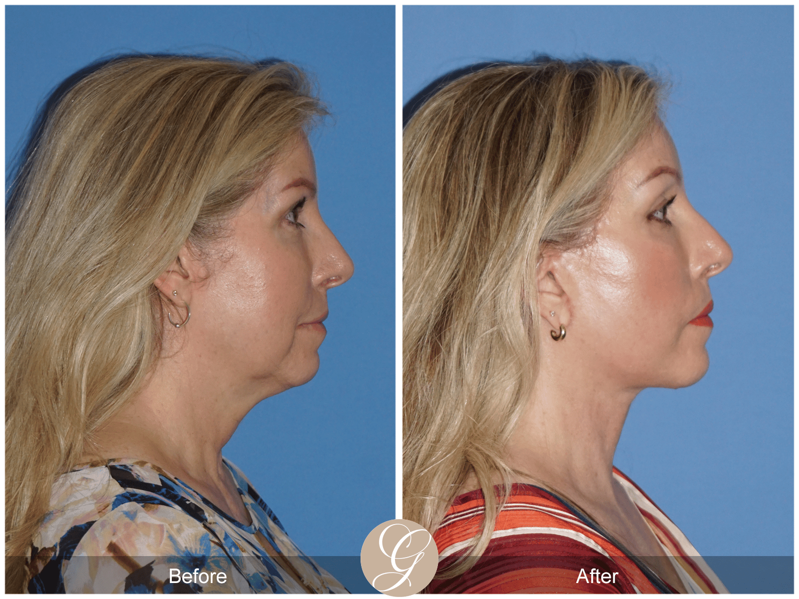 Lower Face and Neck Lift Case 4 Image