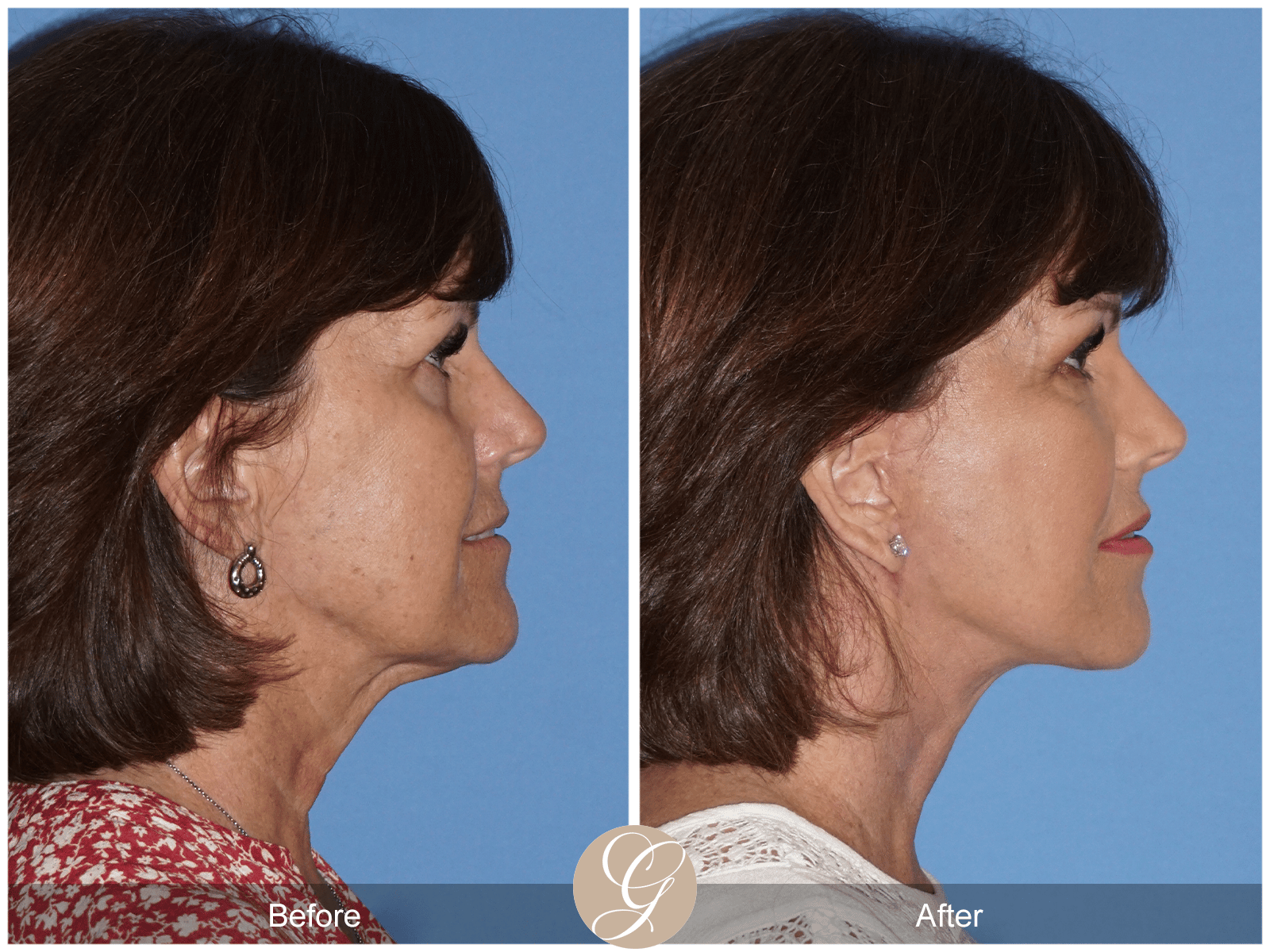 Facelift Case 17 Image