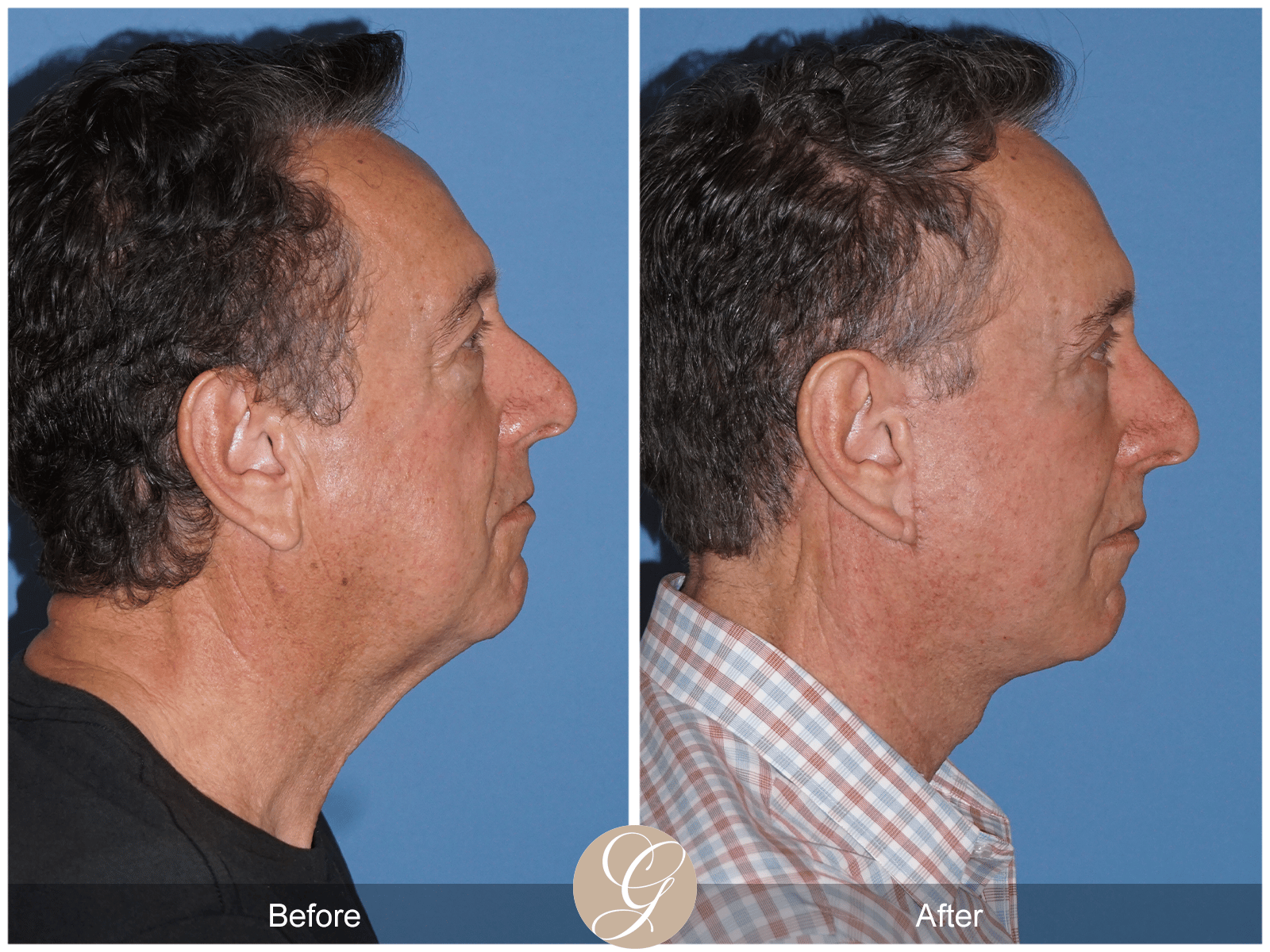 Lower Face and Neck Lift Case 7 Image