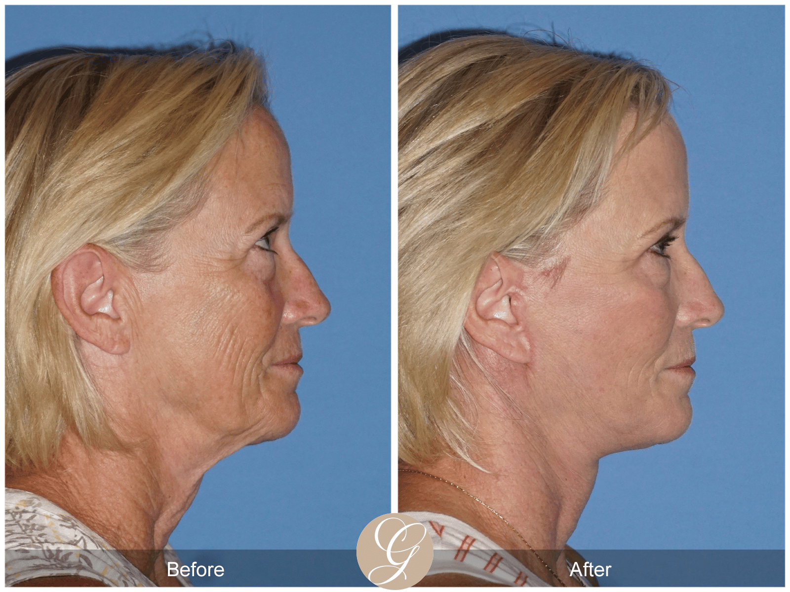Lower Face and Neck Lift Case 6 Image