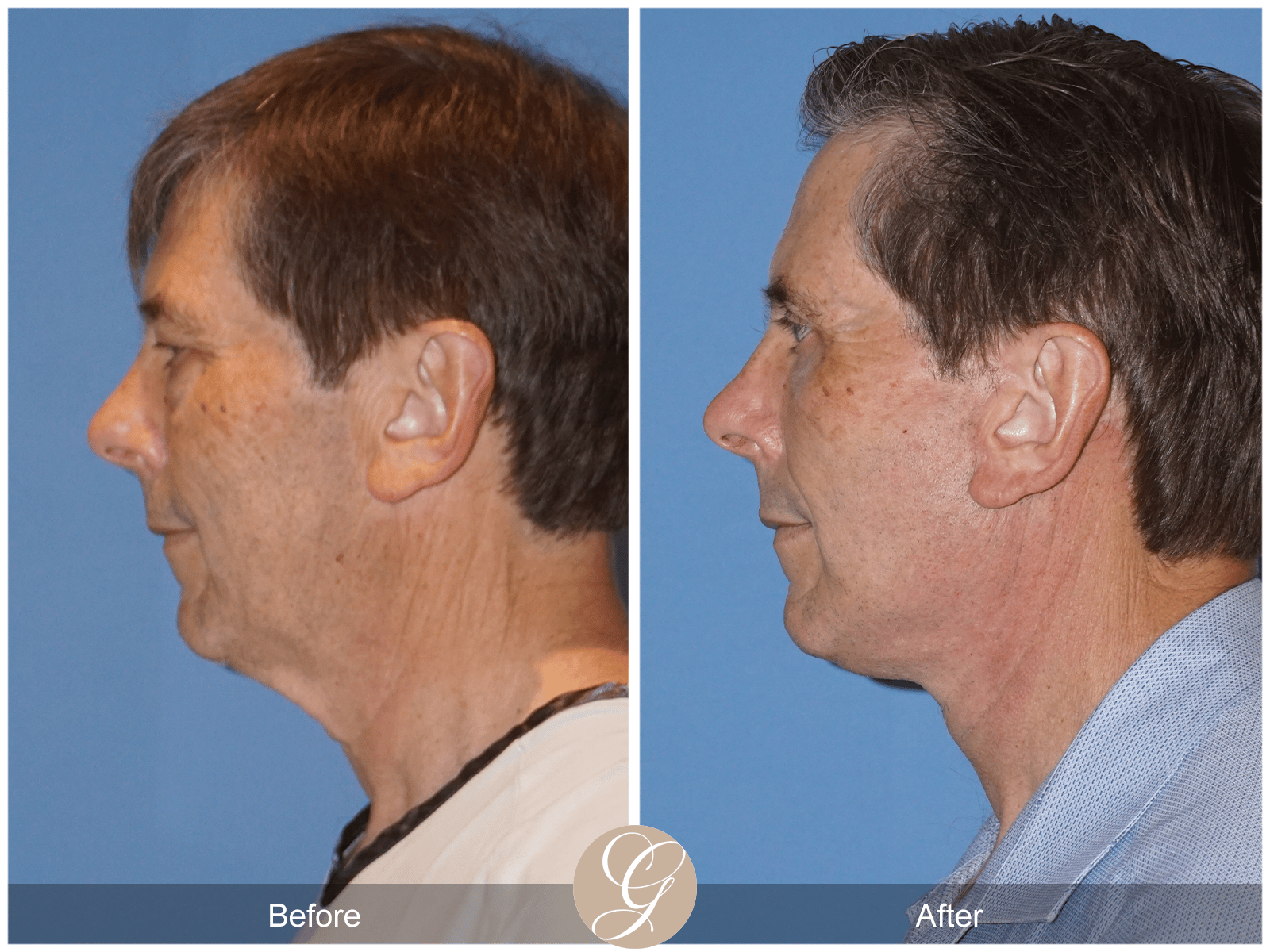Lower Face and Neck Lift Case 5 Image