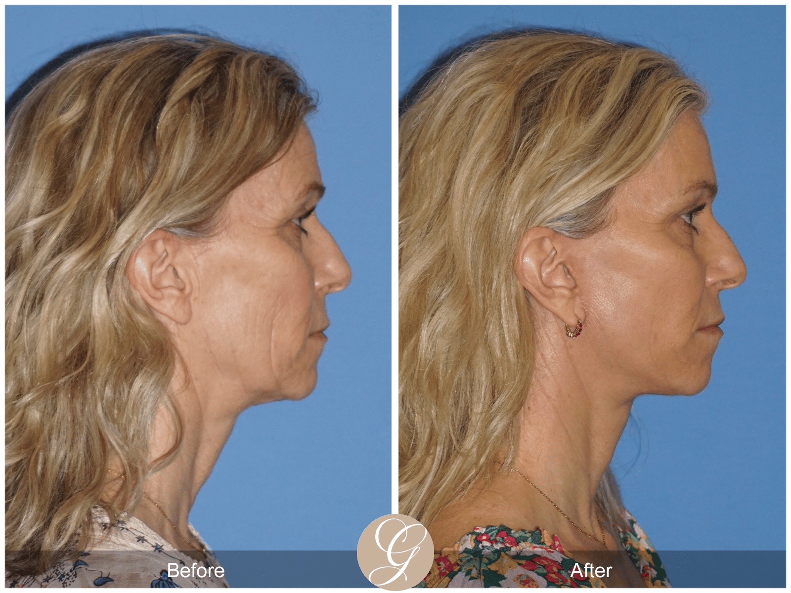 Lower Face and Neck Lift Case 1 Image