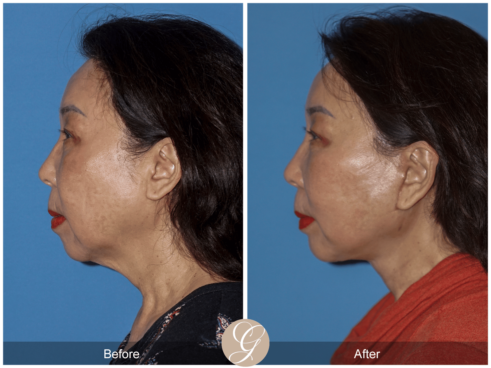 Facelift Case 9 Image