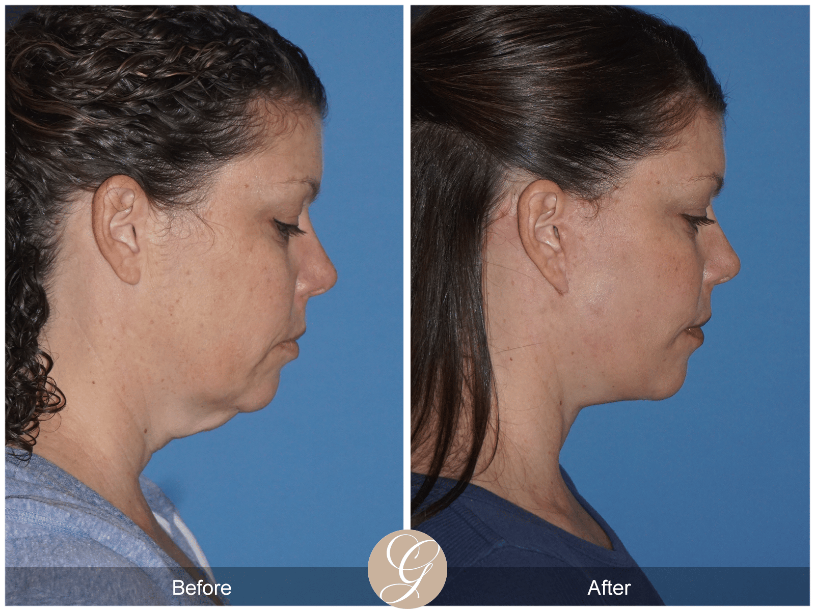 Facelift Case 10 Image