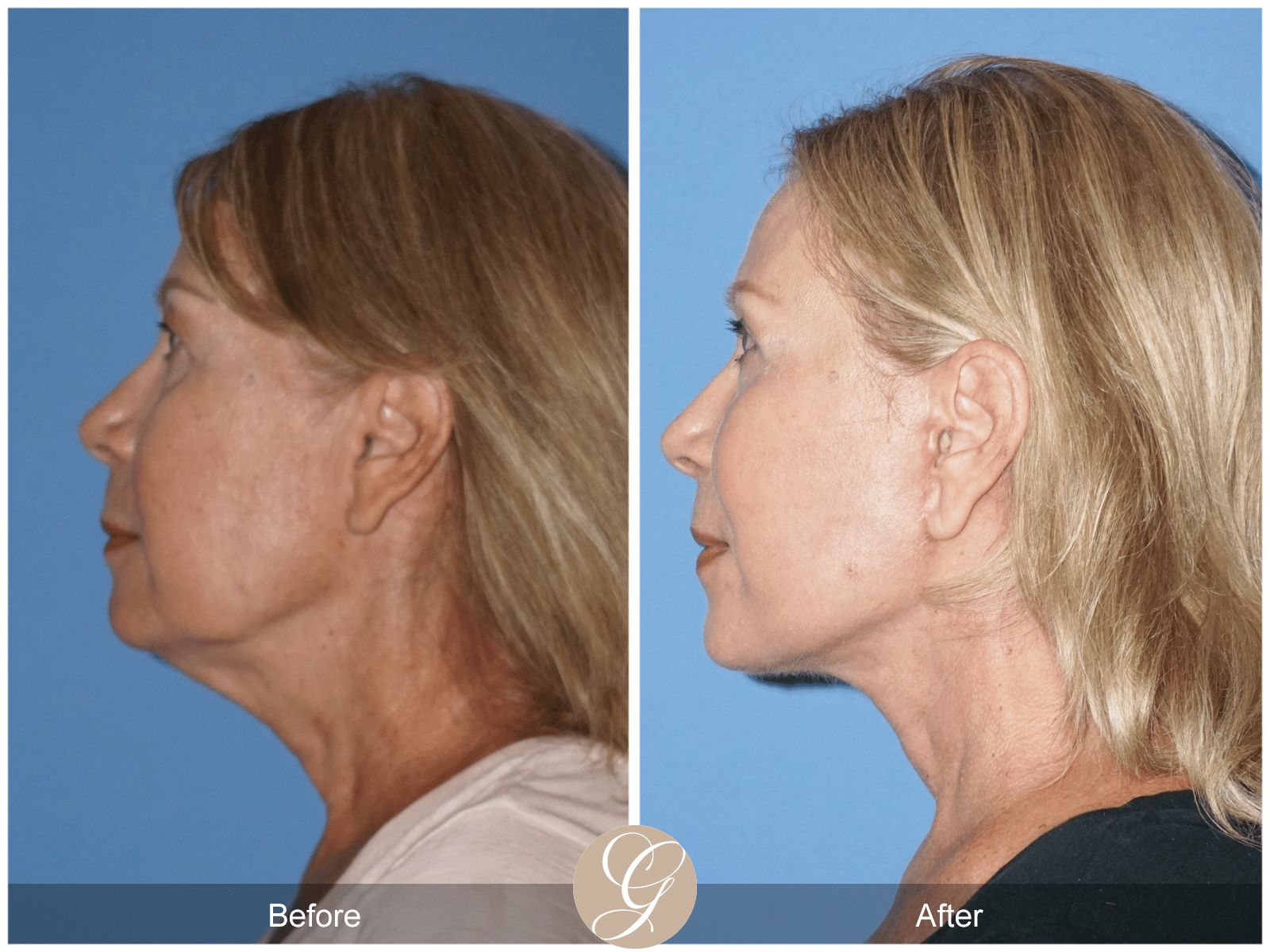 Facelift Case 12 Image