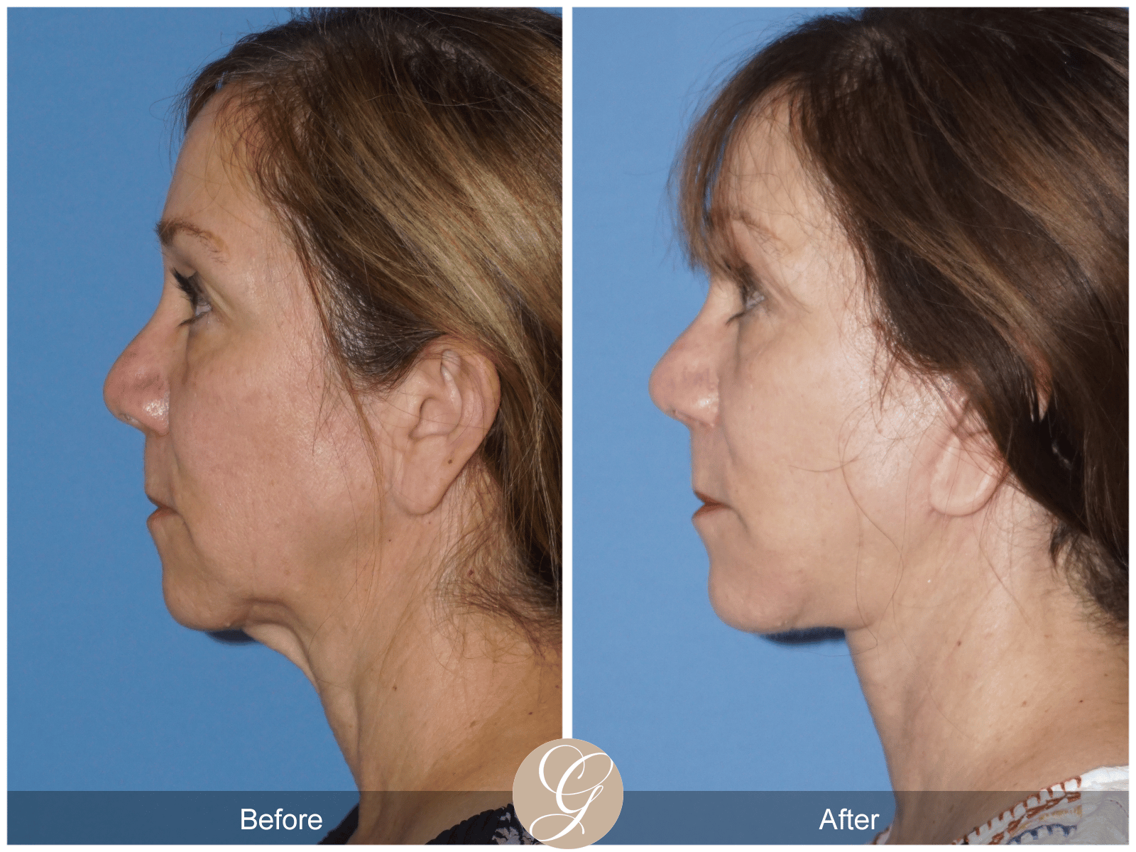 Facelift Case 14 Image