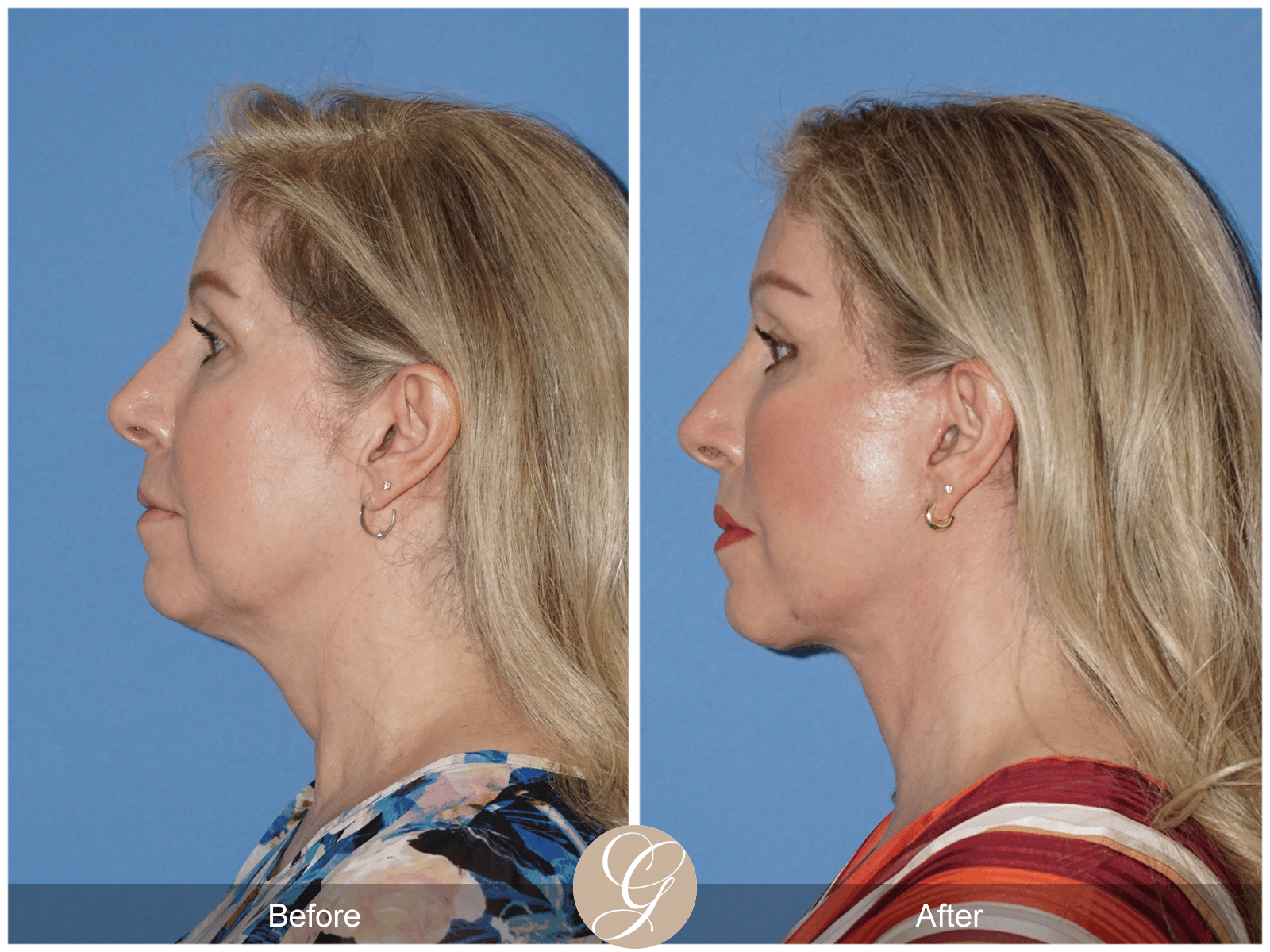 Lower Face and Neck Lift Case 4 Image