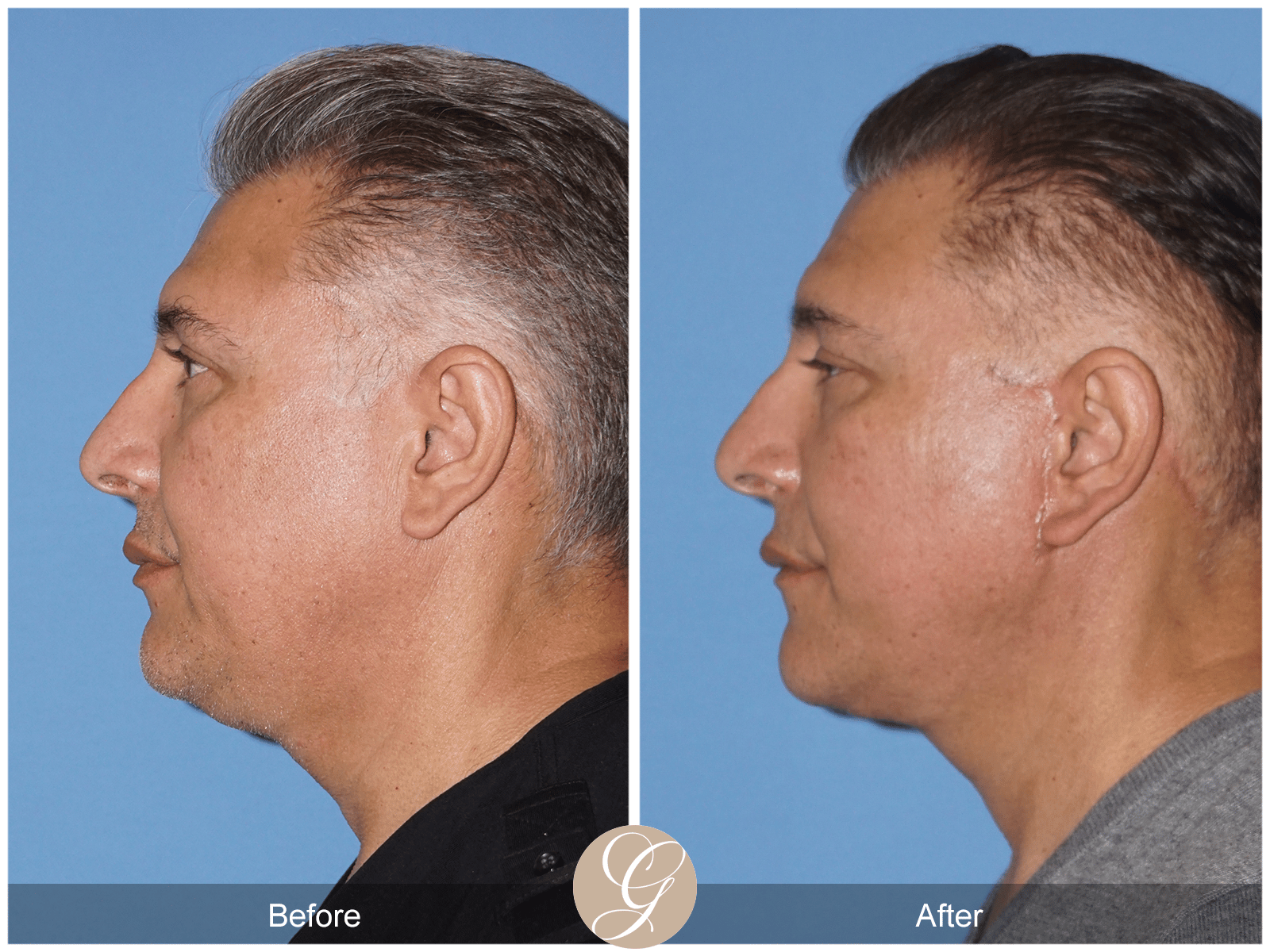 Facelift Case 16 Image