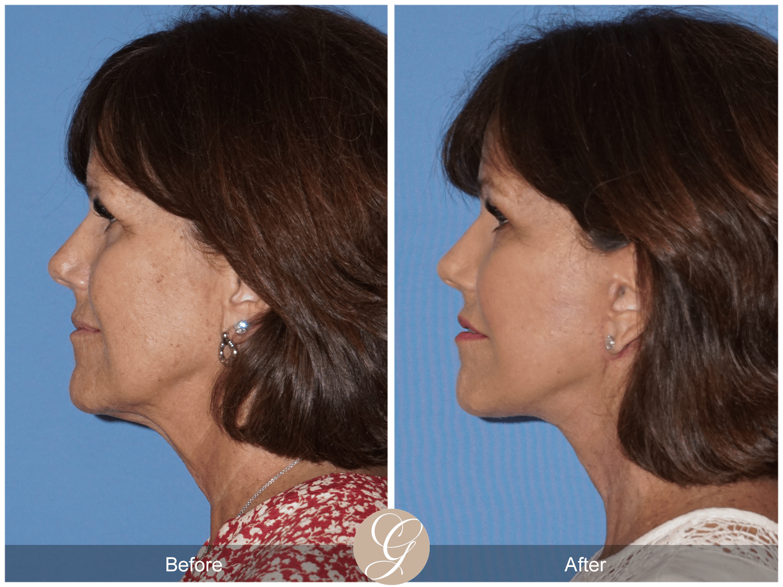 Facelift Case 17 Image