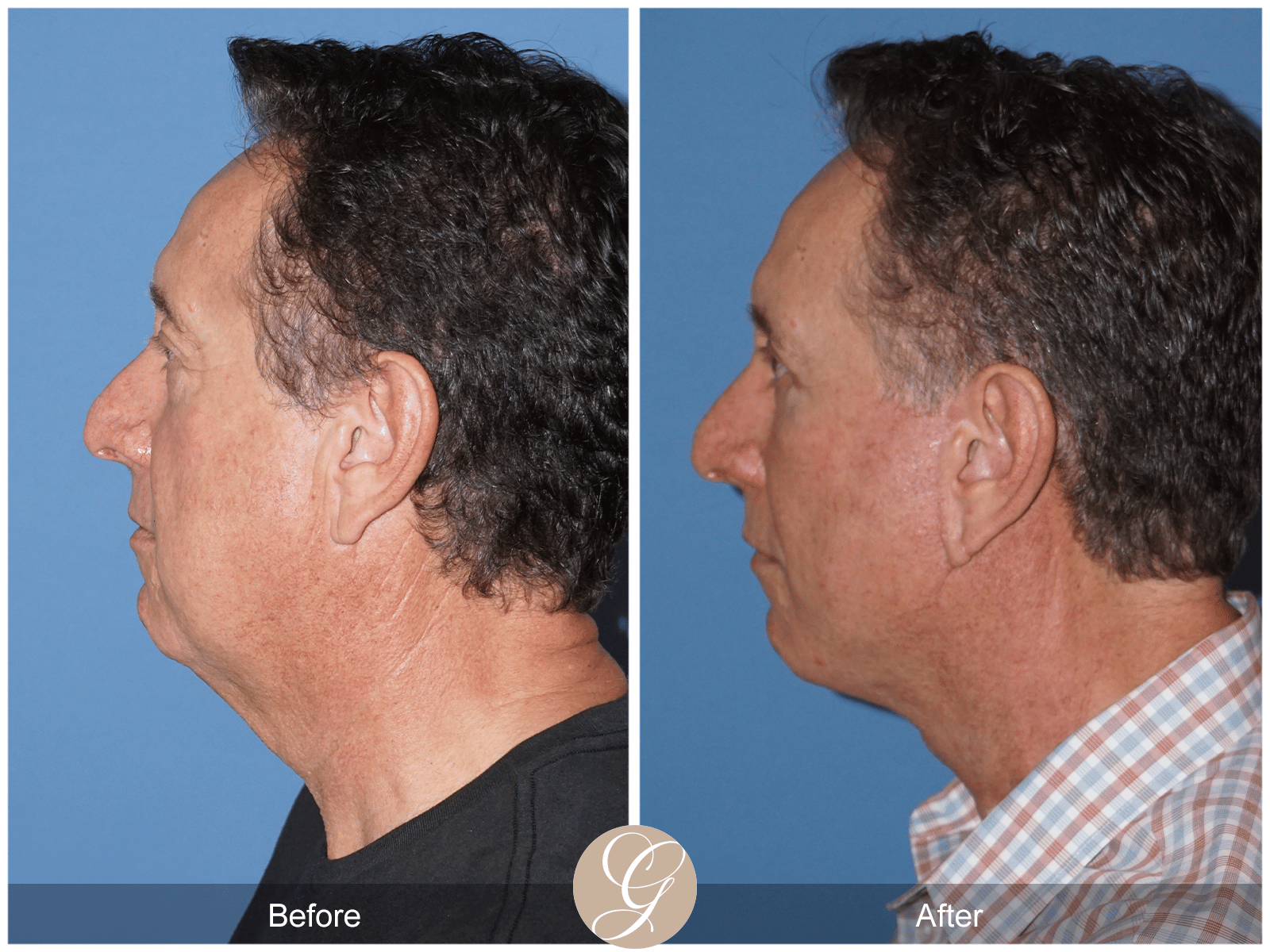 Lower Face and Neck Lift Case 7 Image