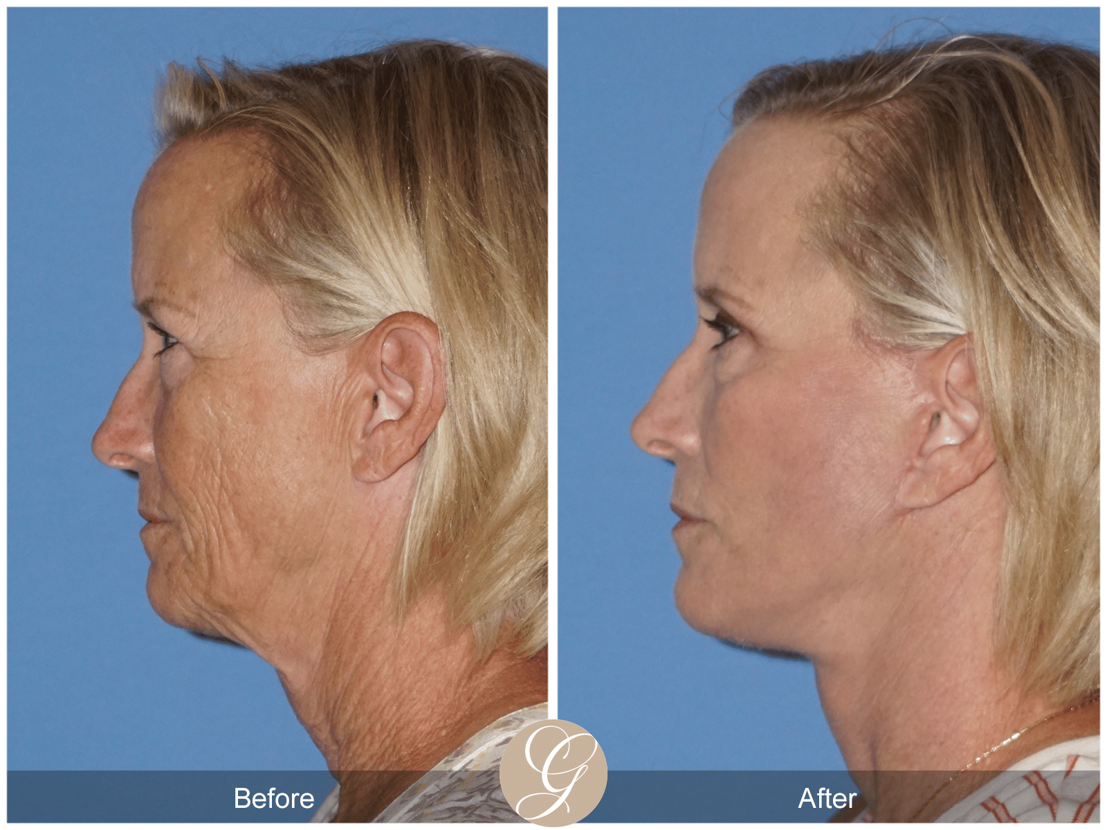 Lower Face and Neck Lift Case 6 Image