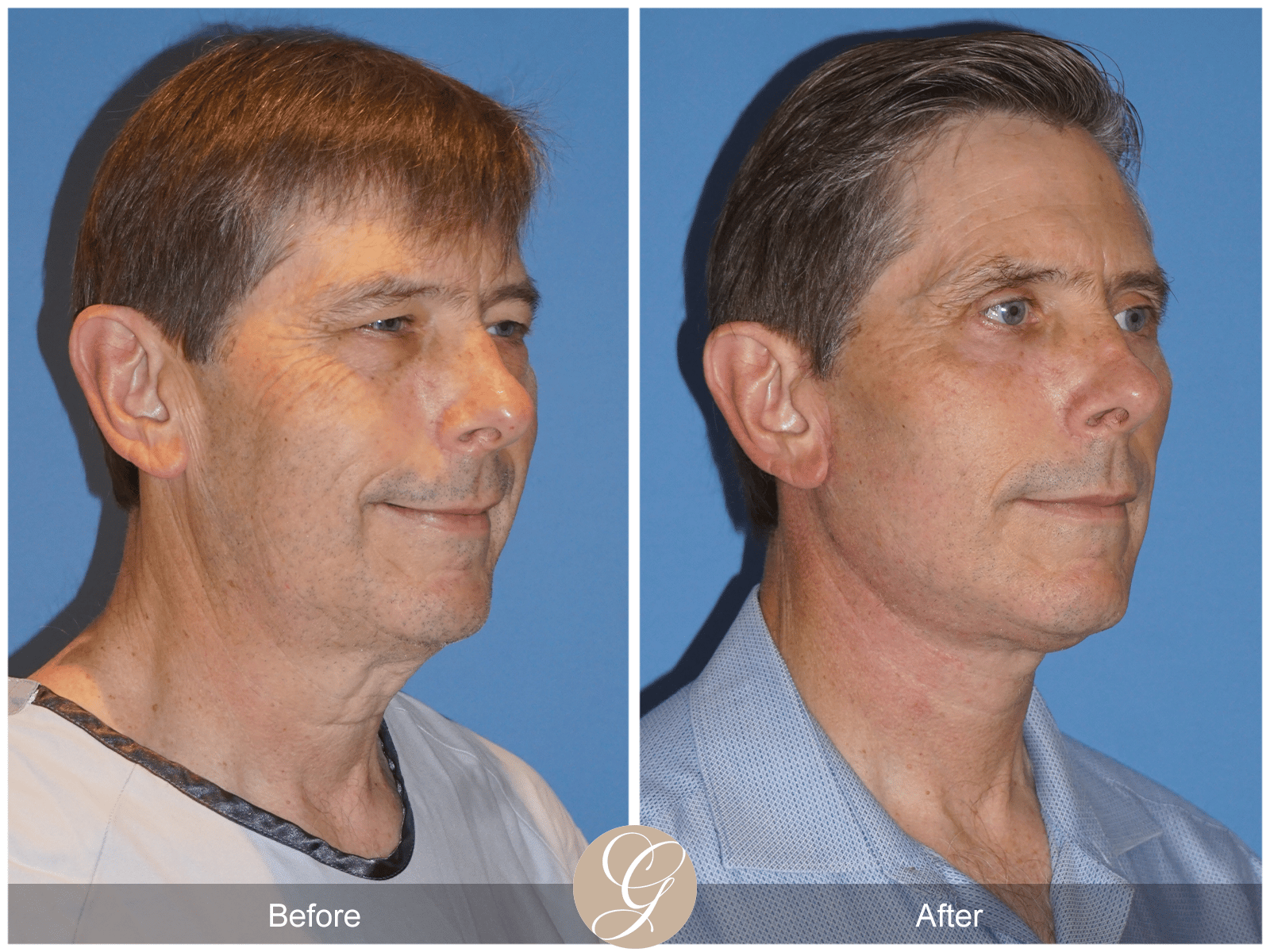 Lower Face and Neck Lift Case 5 Image