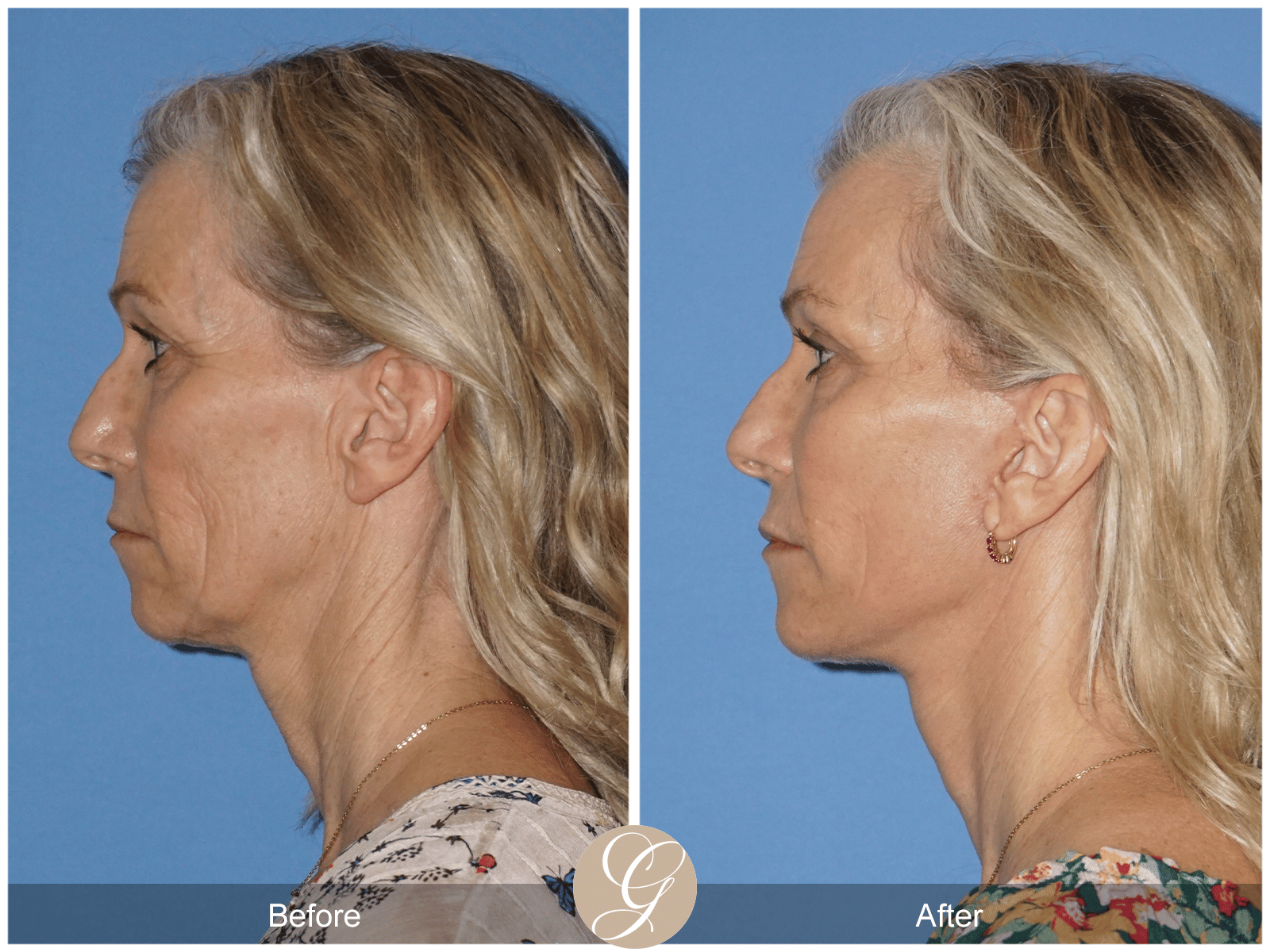 Lower Face and Neck Lift Case 1 Image