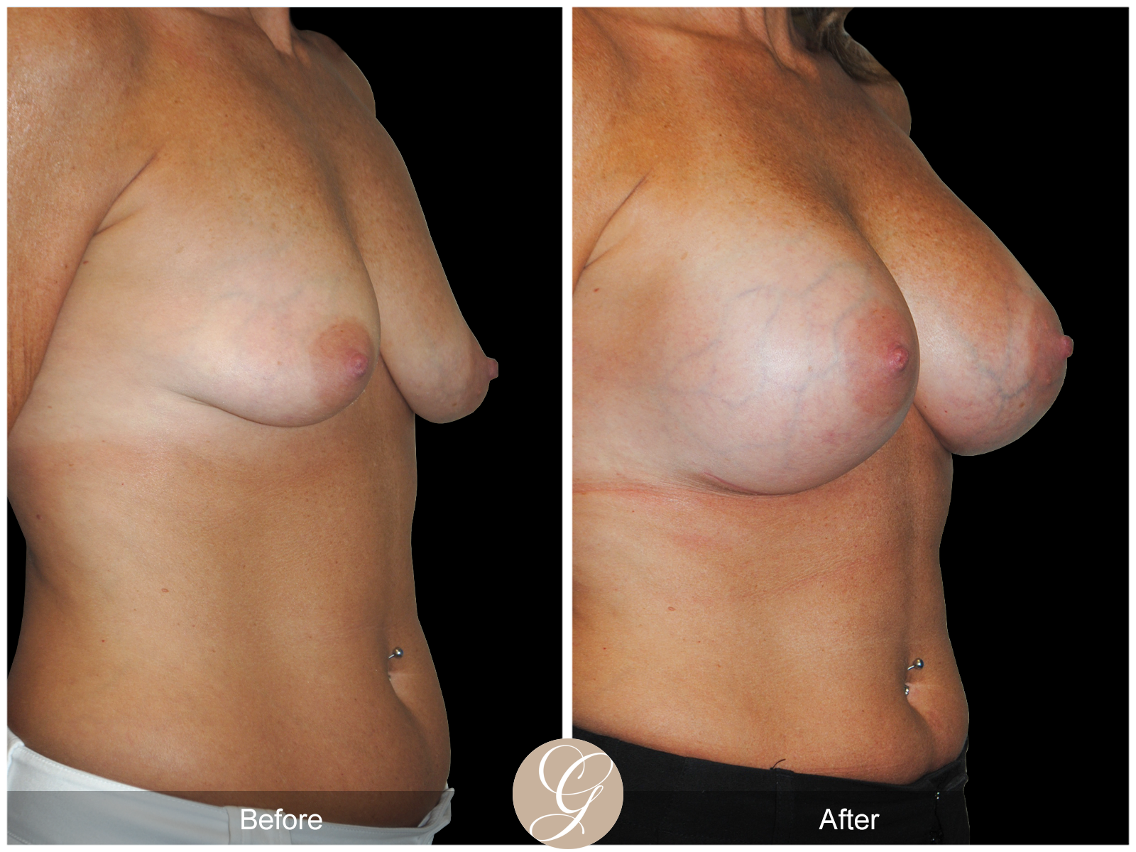 Subfascial Breast Augmentation Pt 22 Image