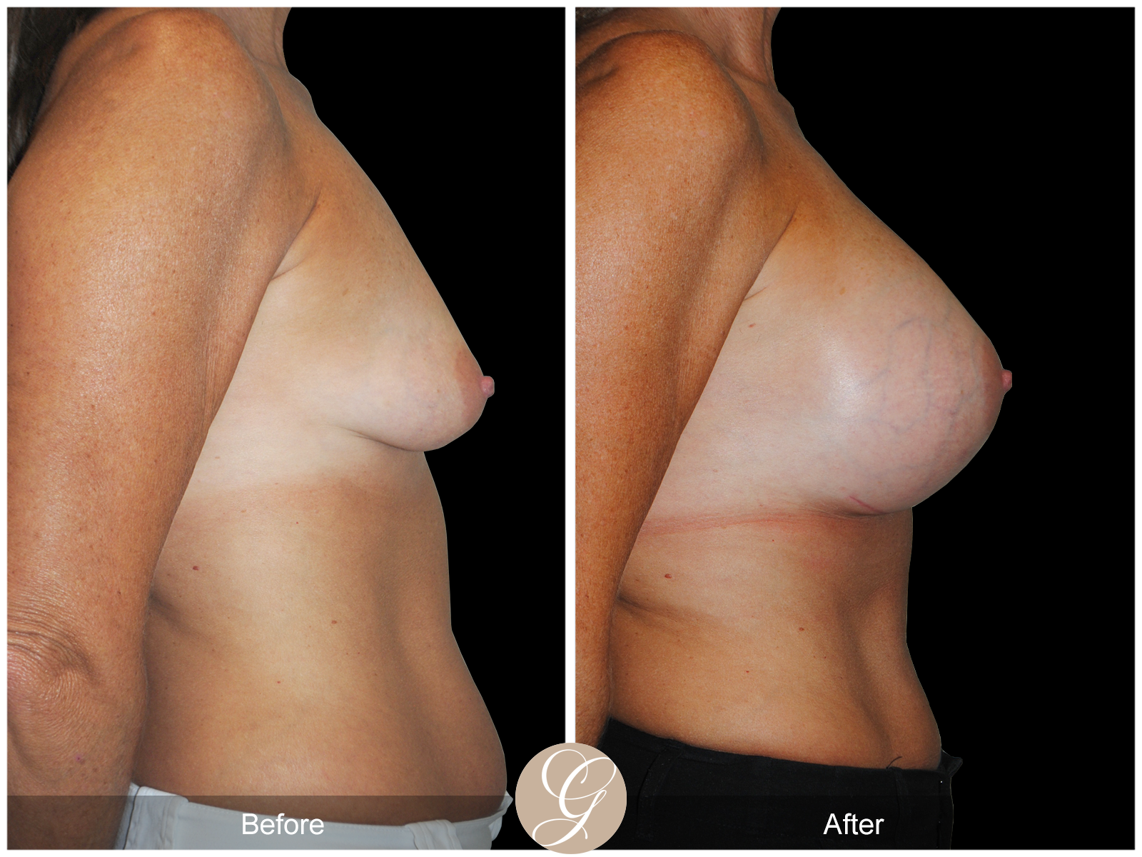 Subfascial Breast Augmentation Pt 22 Image
