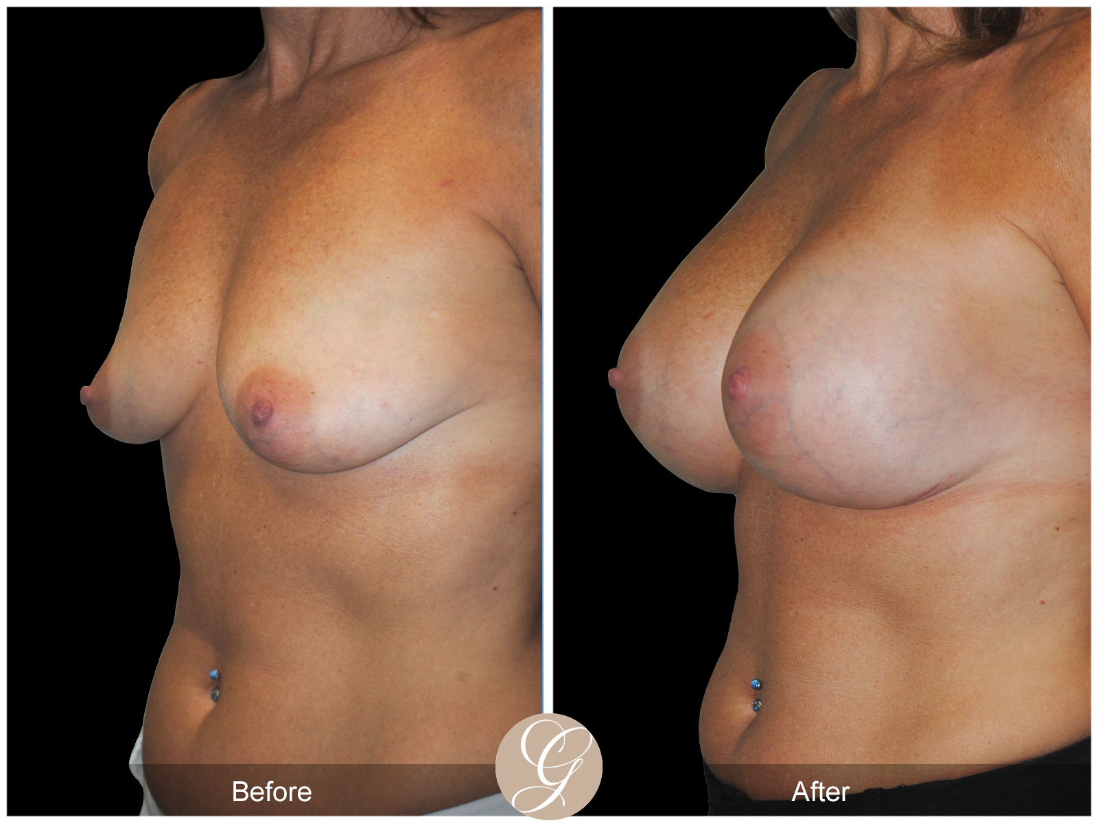 Subfascial Breast Augmentation Pt 22 Image