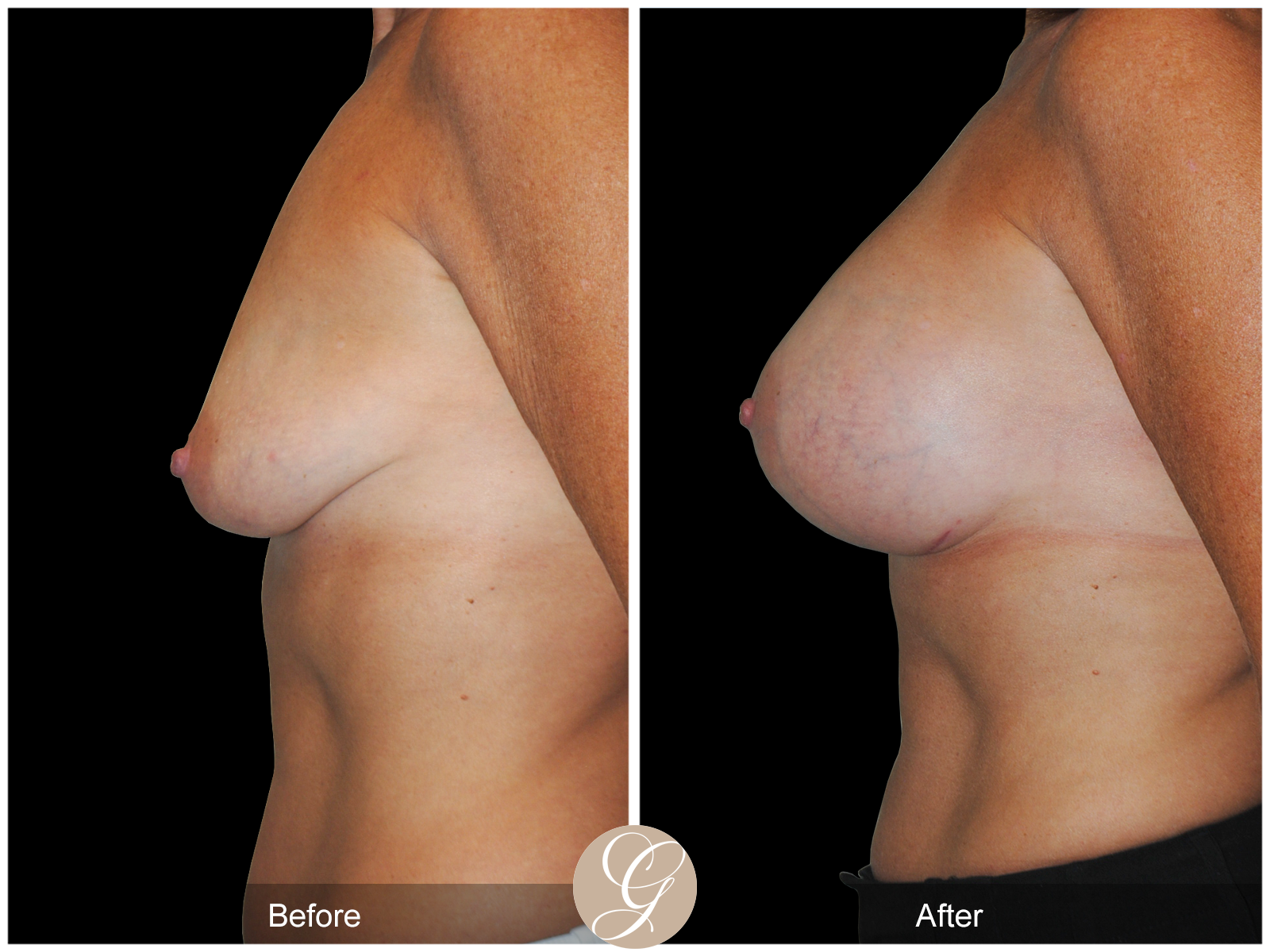 Subfascial Breast Augmentation Pt 22 Image