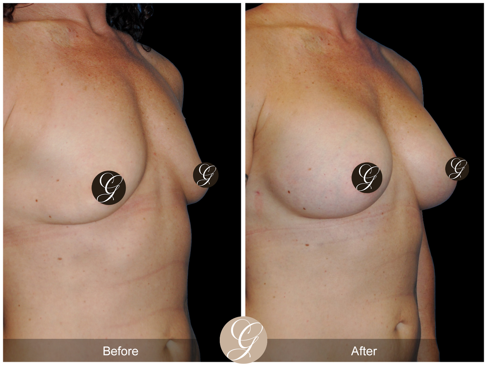 Breast Augmentation Pt 23 Image