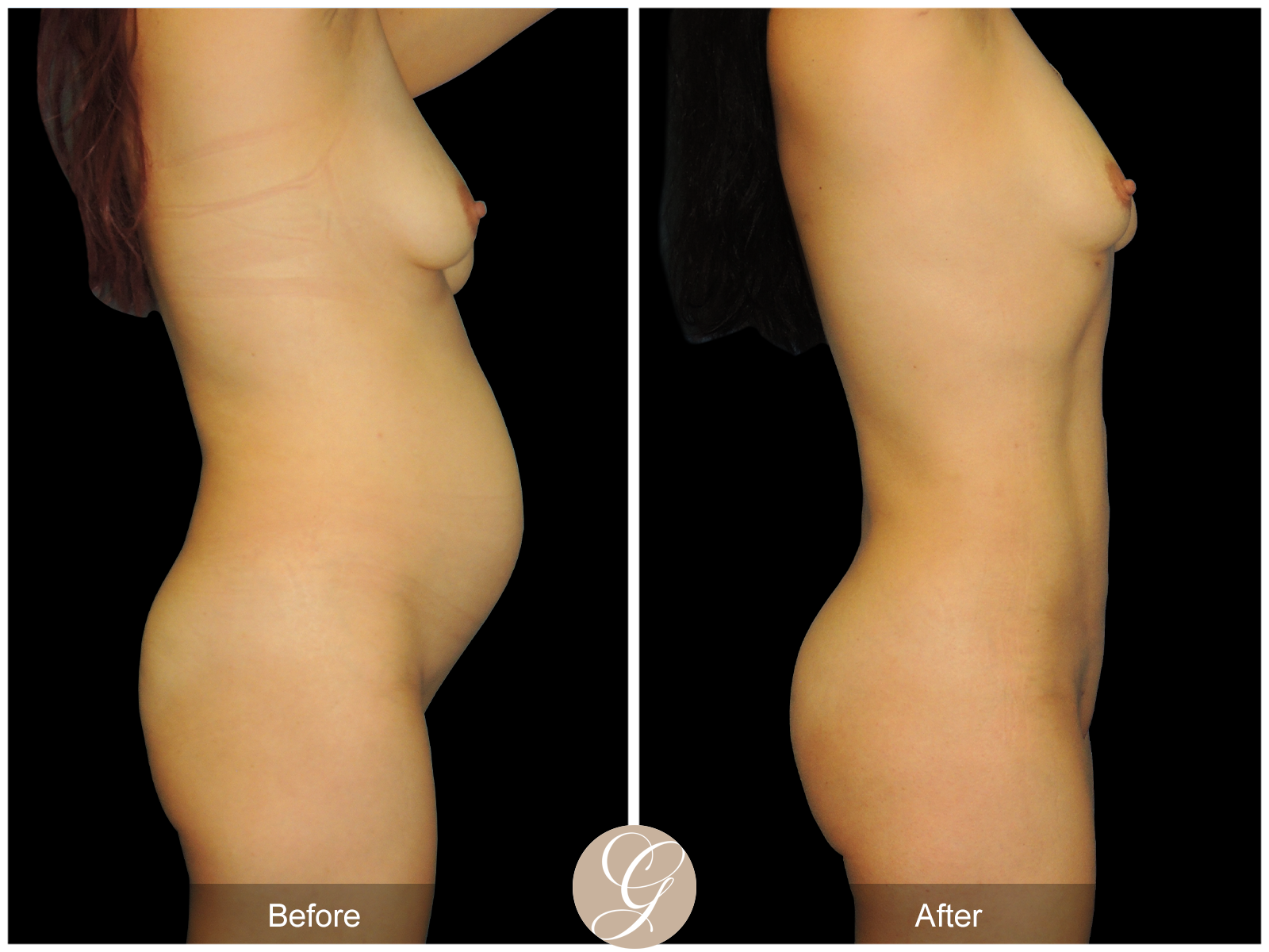 HI-DEF Liposuction Pt 1 Image