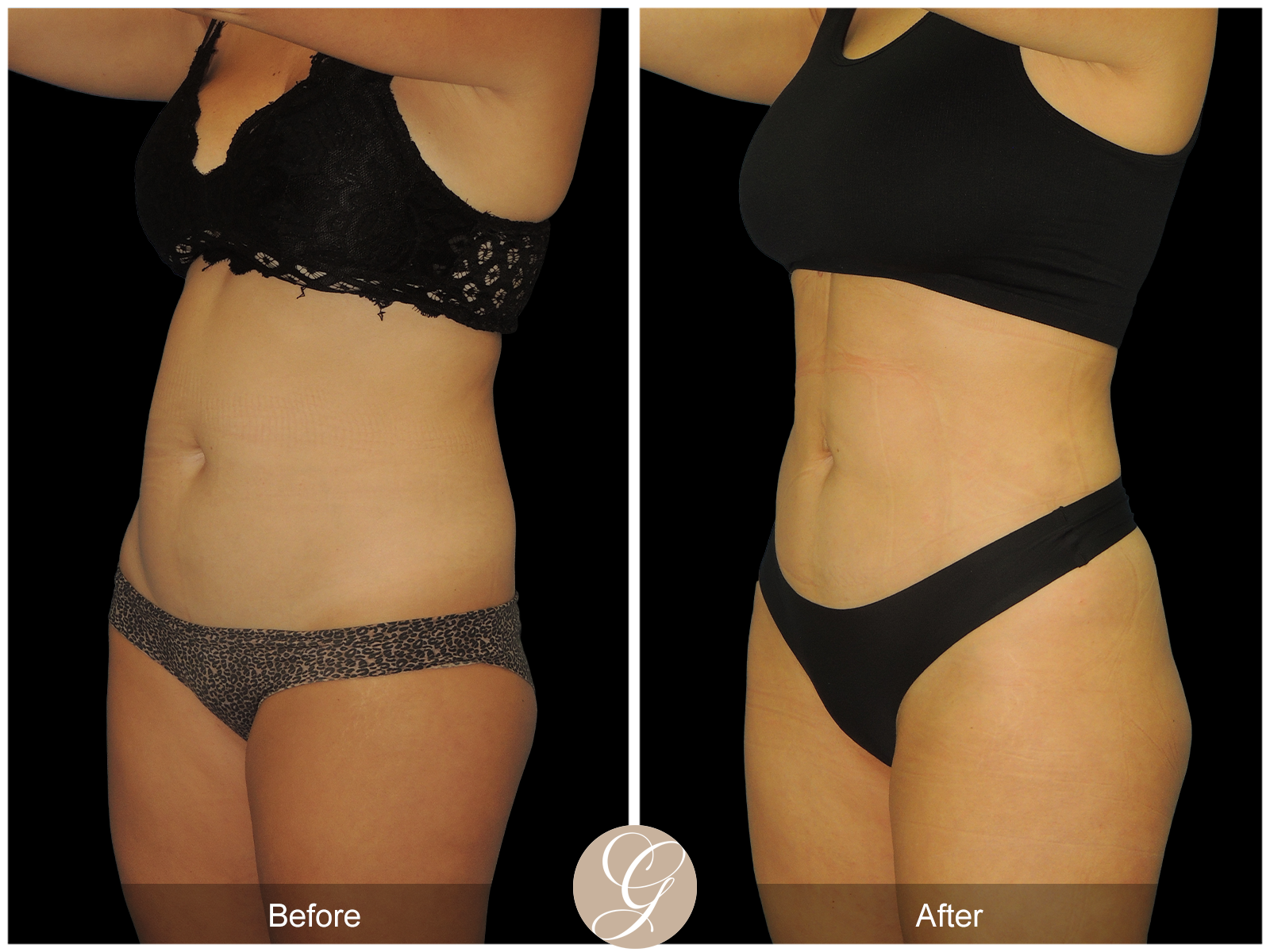 HI-DEF Liposuction Pt 2 Image