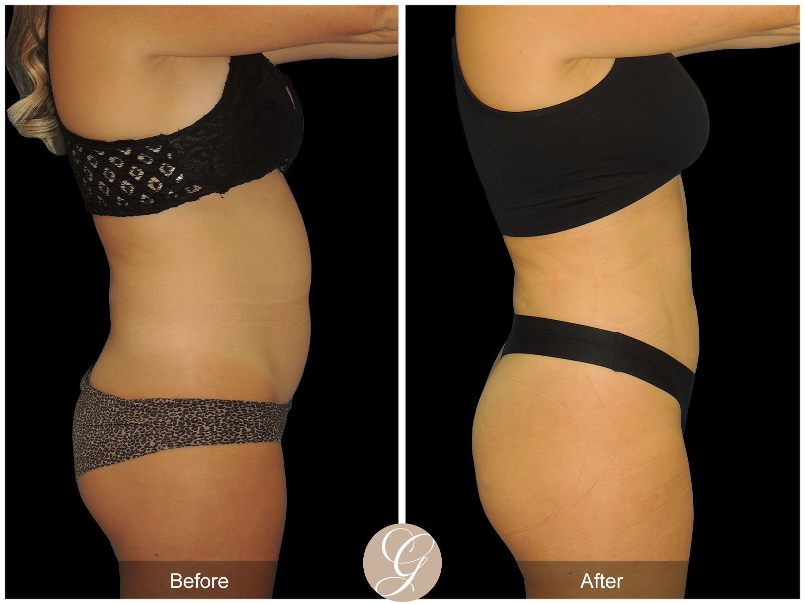 HI-DEF Liposuction Pt 2 Image