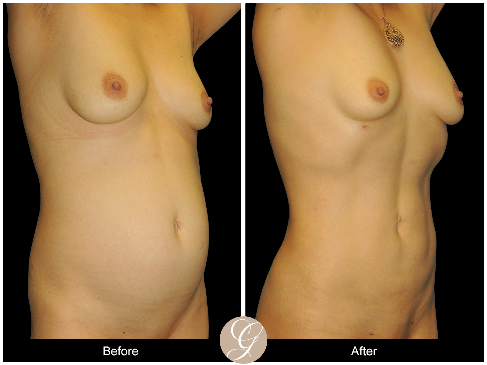 HI-DEF Liposuction Pt 1 Image