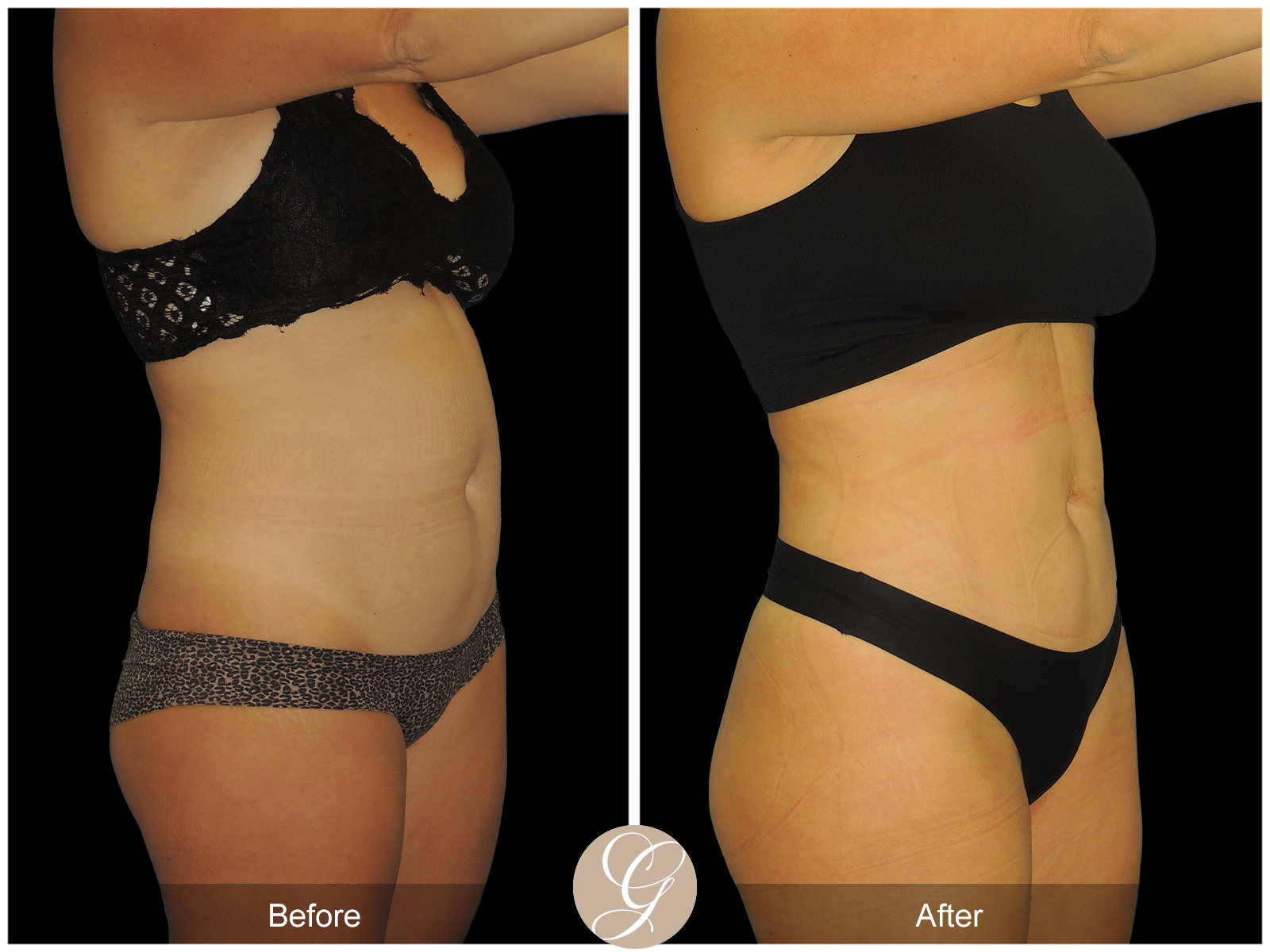 HI-DEF Liposuction Pt 2 Image