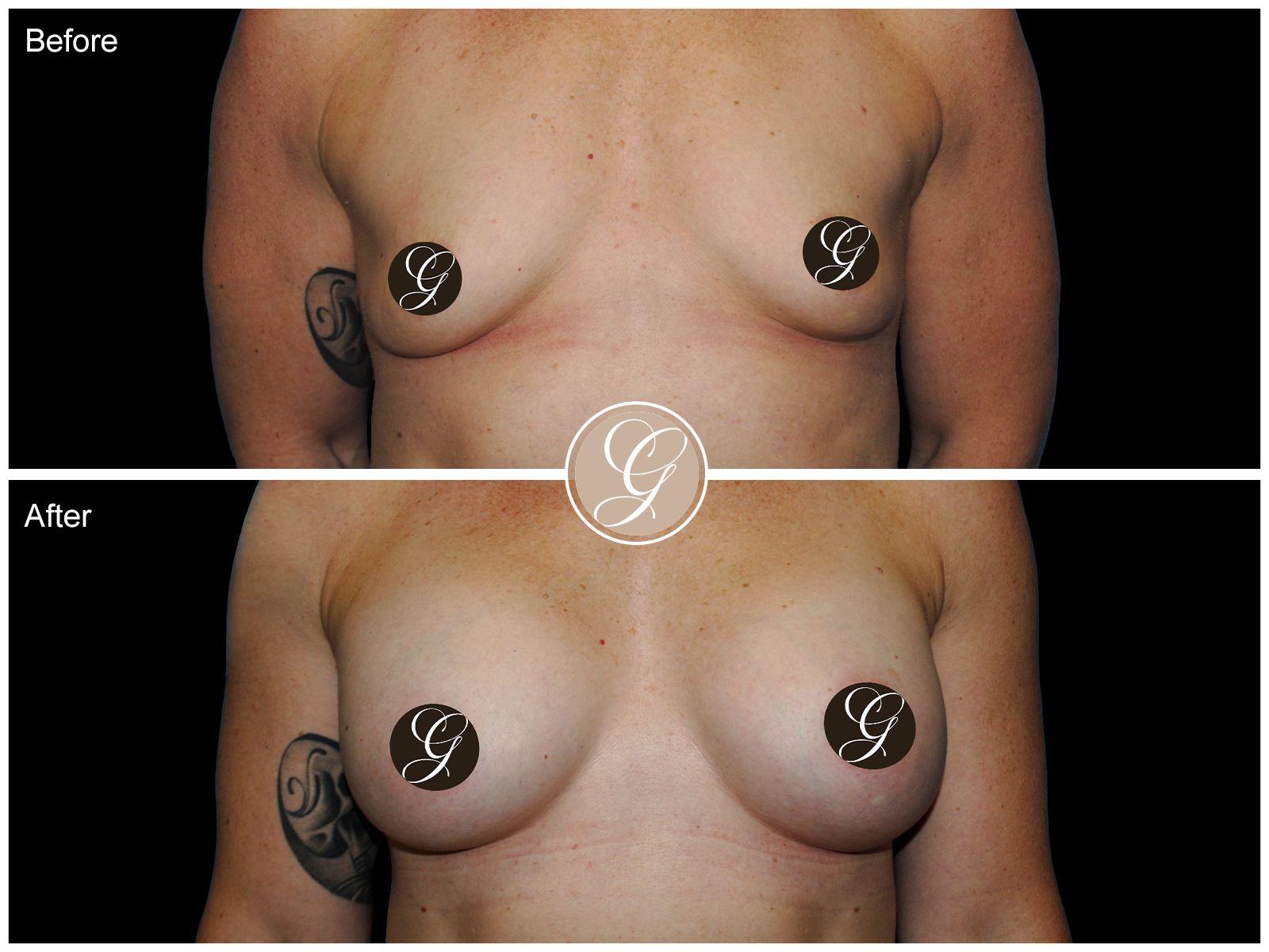 Breast Augmentation Pt 23 Image