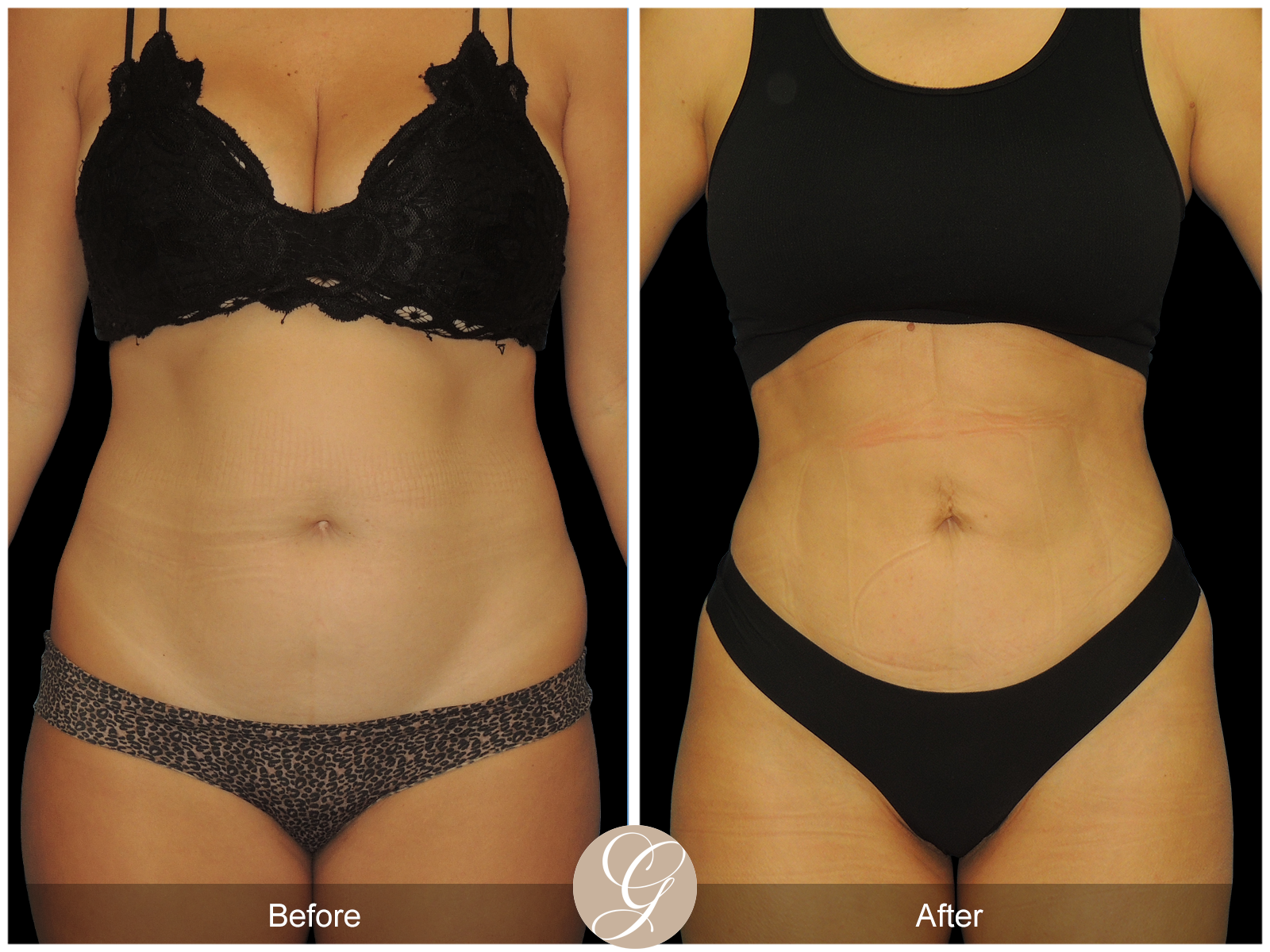 HI-DEF Liposuction Pt 2 Image