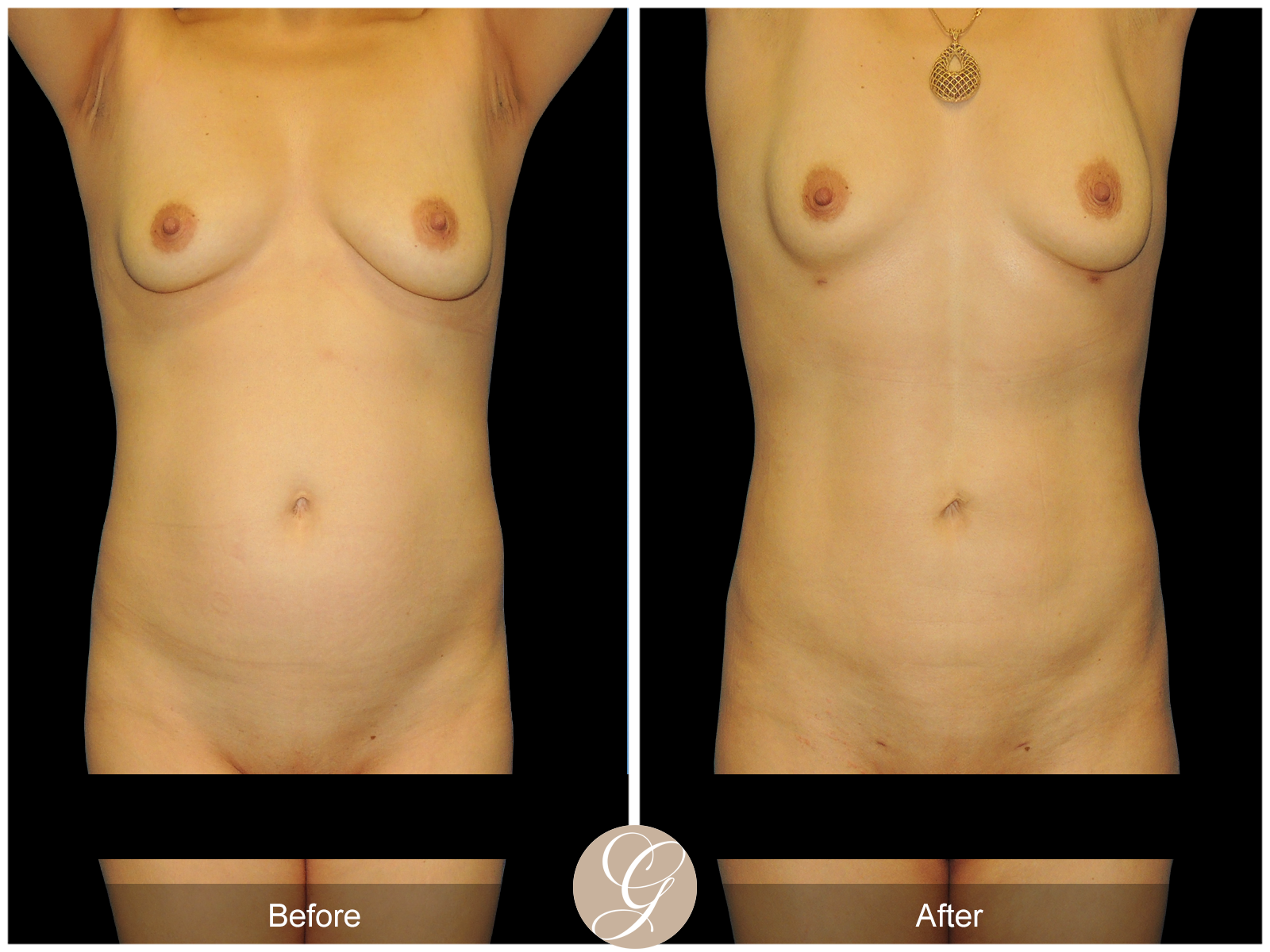 HI-DEF Liposuction Pt 1 Image