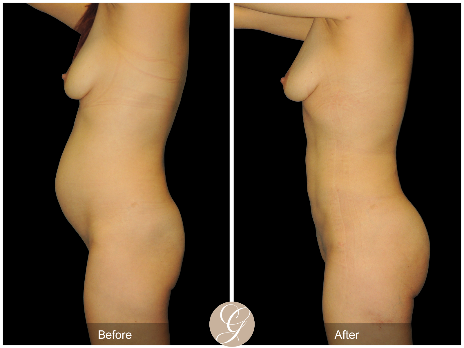 HI-DEF Liposuction Pt 1 Image