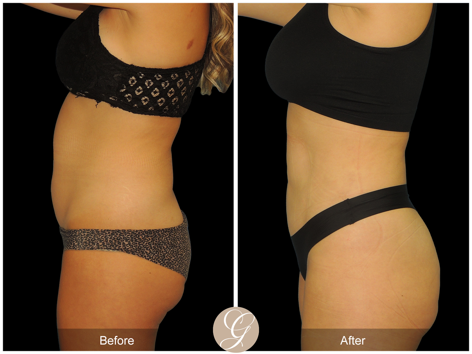 HI-DEF Liposuction Pt 2 Image