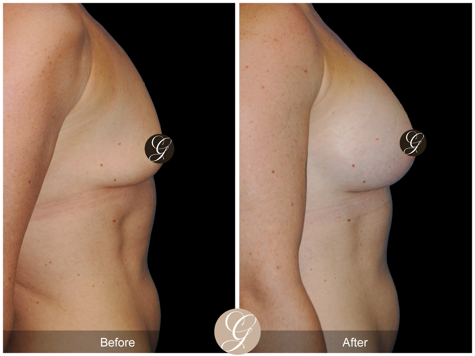 Breast Augmentation Pt 23 Image