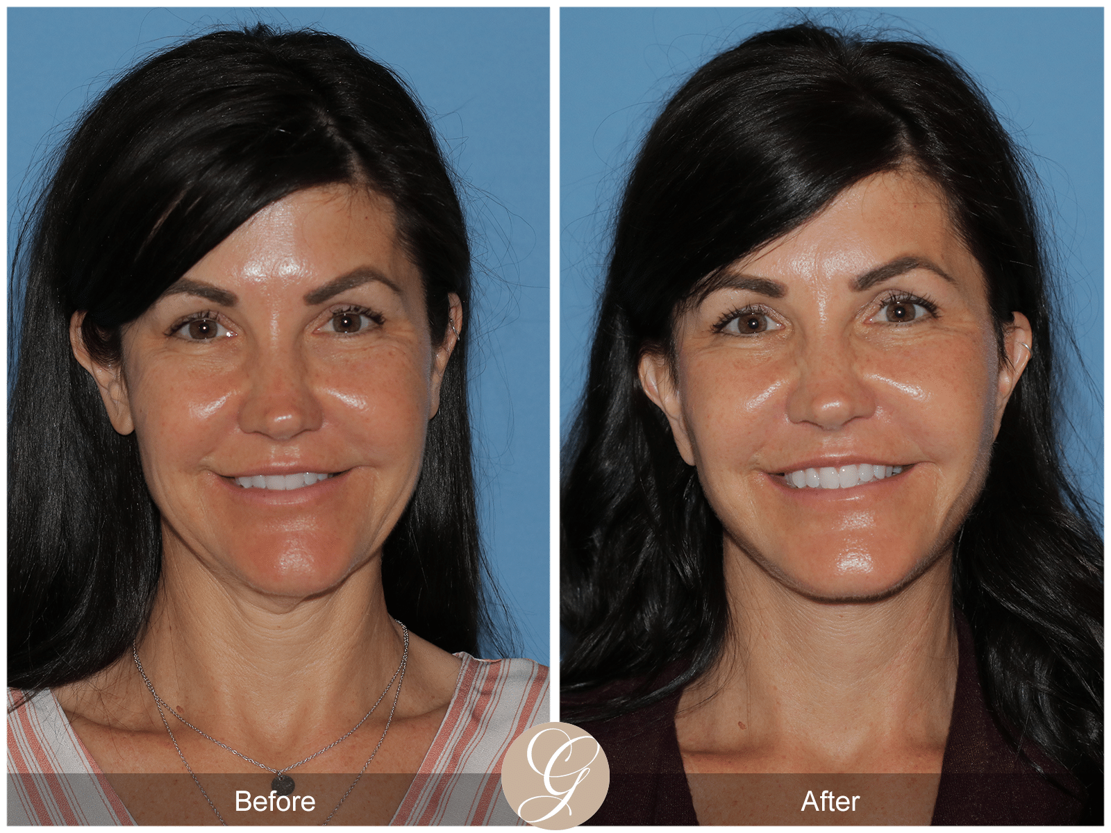 Lower Facelift and Deep Plane Necklift Case 1 Image